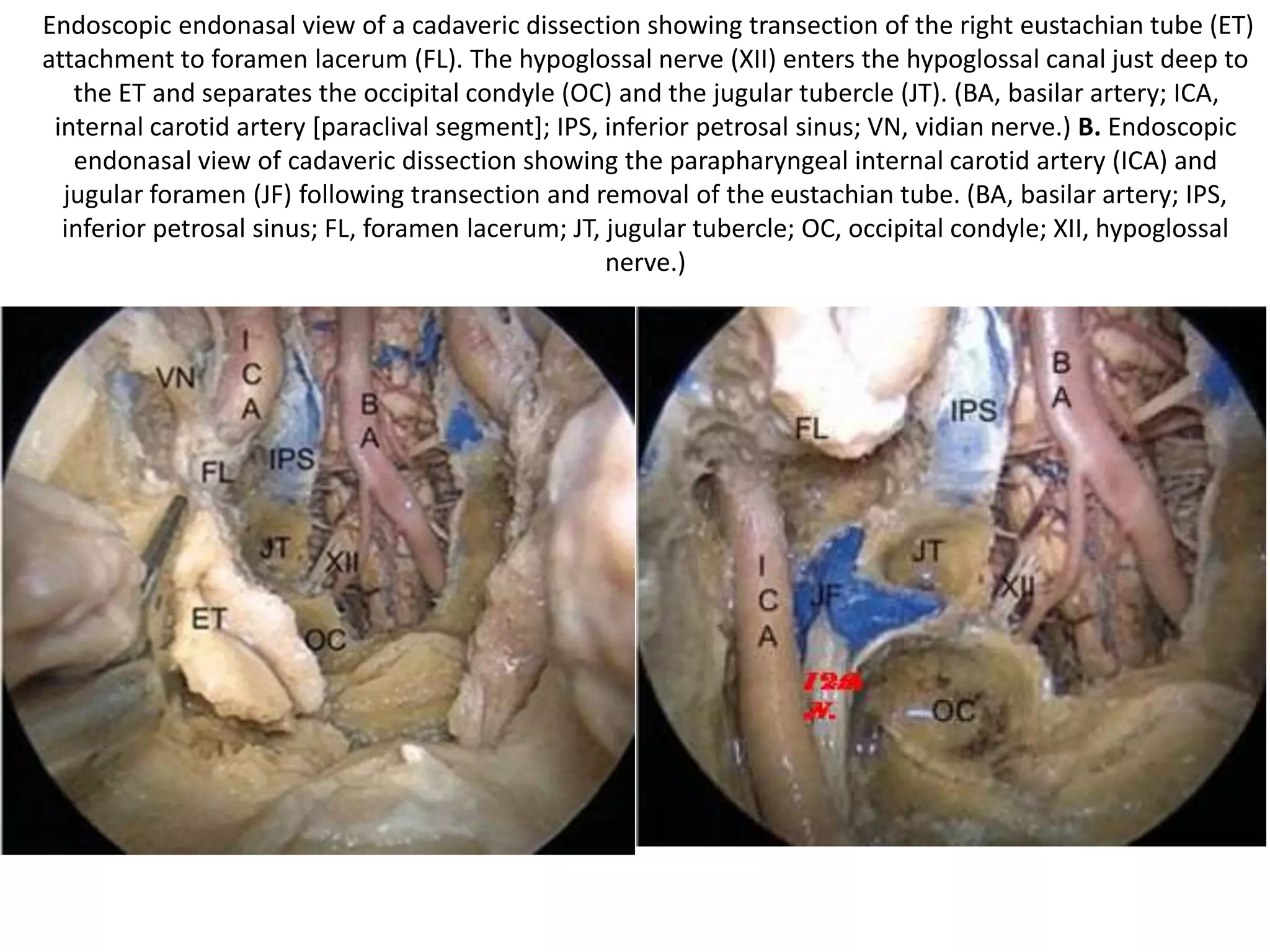 Note CL [Mid clivus above FL & lower
clivus below FL ] in these photos after
drilling of cochlea
BT- basal turn of the cochlea Fig. 8.34 The bone medial to the
internal carotid artery (ICA) has been
drilled and the clivus bone (CL) has
been reached. FN Facial nerve,
JB Jugular bulb
 