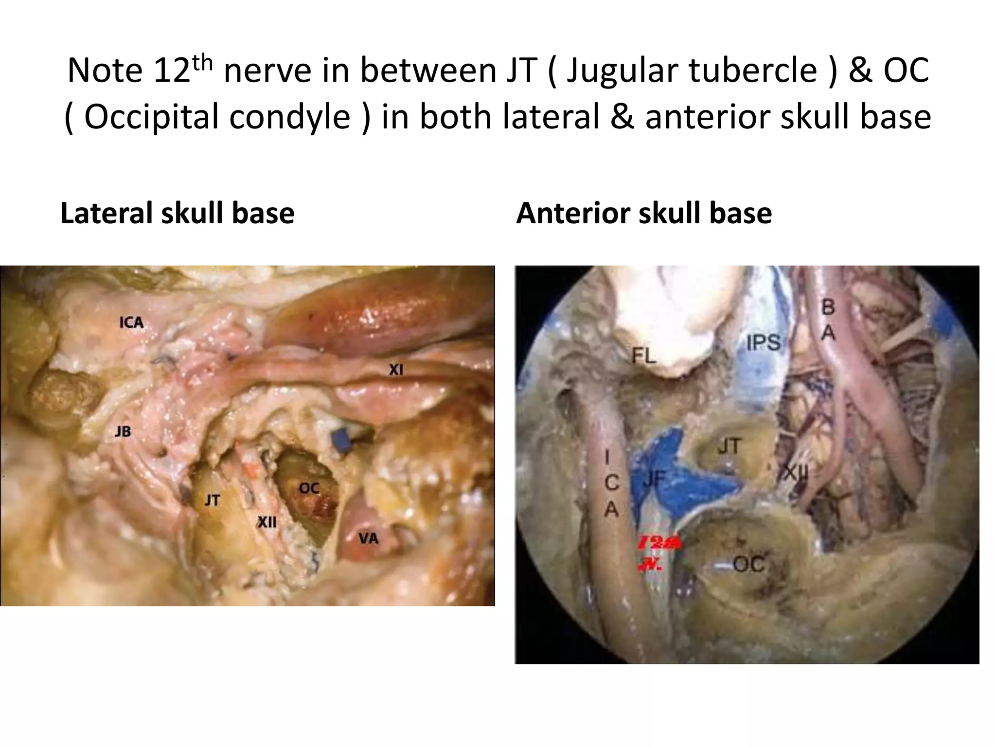 Note CL [Mid clivus above FL & lower
clivus below FL ] in these photos after
drilling of cochlea
Note cochlear aqueduct [ CA ]
Here ICA is vertical part of carotid infront
to cochlea – this is not paraclival carotid
 