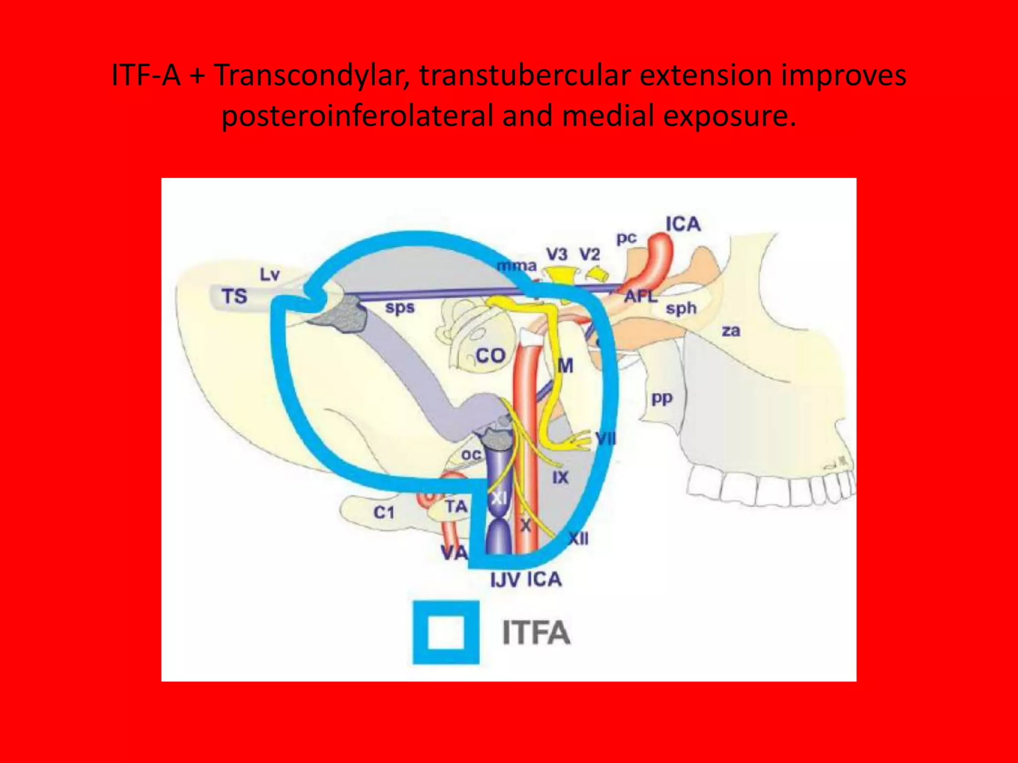 Note CL [Mid clivus above FL & lower
clivus below FL ] in these photos after
drilling of cochleaNote the contralateral vertebral
artery [ CVA ] in below photo
 