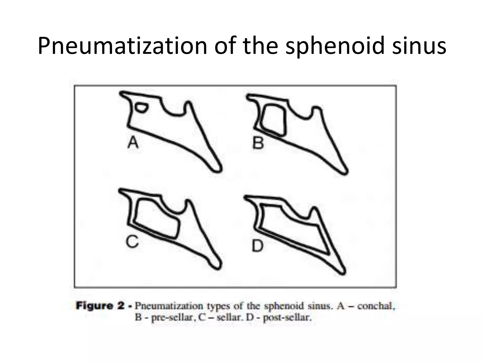 One neurosurgeon classified into 4 quadrants like this
 