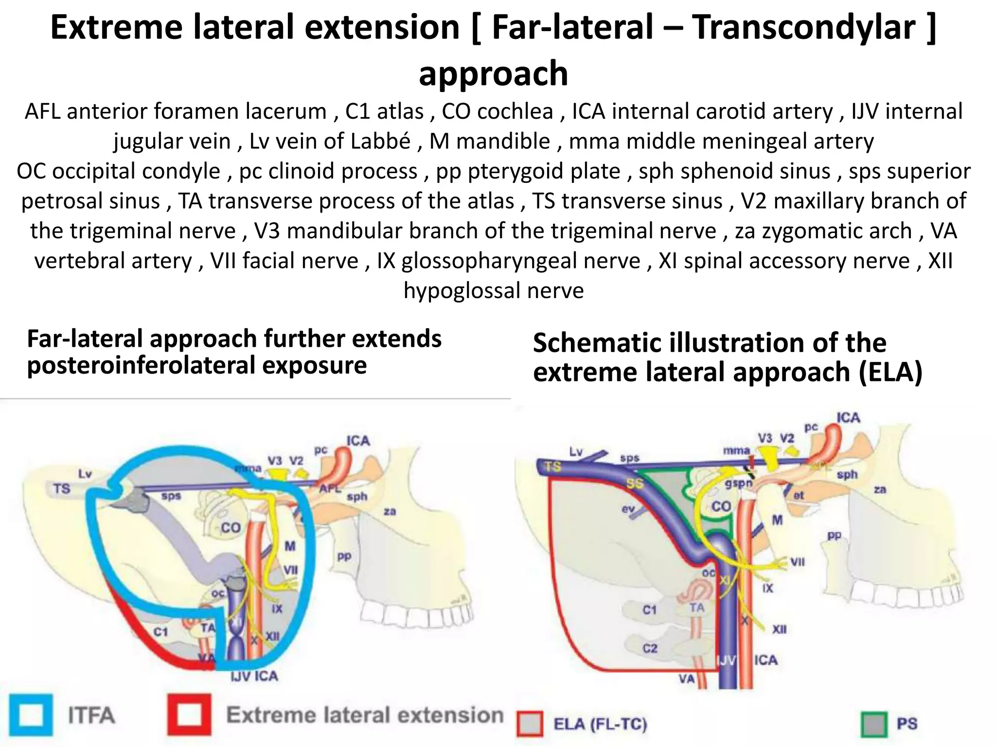 ITFA with Transcondylar [ = TC ]
Transtubercular [ = TT ] approach
Here Transcondylar is through Occipital Condyle ;
Transtubercular is through Jugular tubercle &
lateral pharyngeal tubercle
 