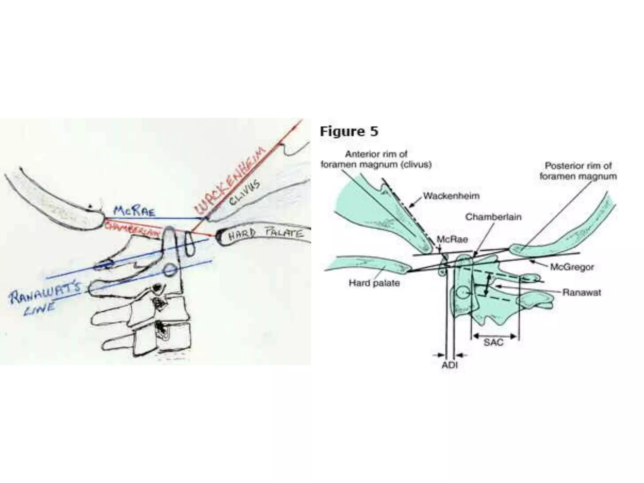 Endoscopic endonasal view of a cadaveric dissection showing transection of the right eustachian tube (ET)
attachment to foramen lacerum (FL). The hypoglossal nerve (XII) enters the hypoglossal canal just deep to
the ET and separates the occipital condyle (OC) and the jugular tubercle (JT). (BA, basilar artery; ICA,
internal carotid artery [paraclival segment]; IPS, inferior petrosal sinus; VN, vidian nerve.) B. Endoscopic
endonasal view of cadaveric dissection showing the parapharyngeal internal carotid artery (ICA) and
jugular foramen (JF) following transection and removal of the eustachian tube. (BA, basilar artery; IPS,
inferior petrosal sinus; FL, foramen lacerum; JT, jugular tubercle; OC, occipital condyle; XII, hypoglossal
nerve.)
 