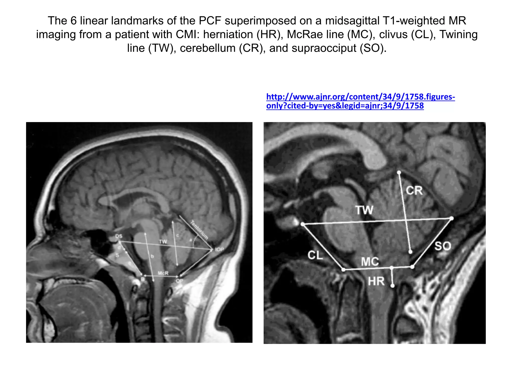 Hypoglossal is just behind the upper end of
parapharyngel carotid – very easy way to
identify 12th nerve in paraphayrngeal space
– Dr.Satish jain
 