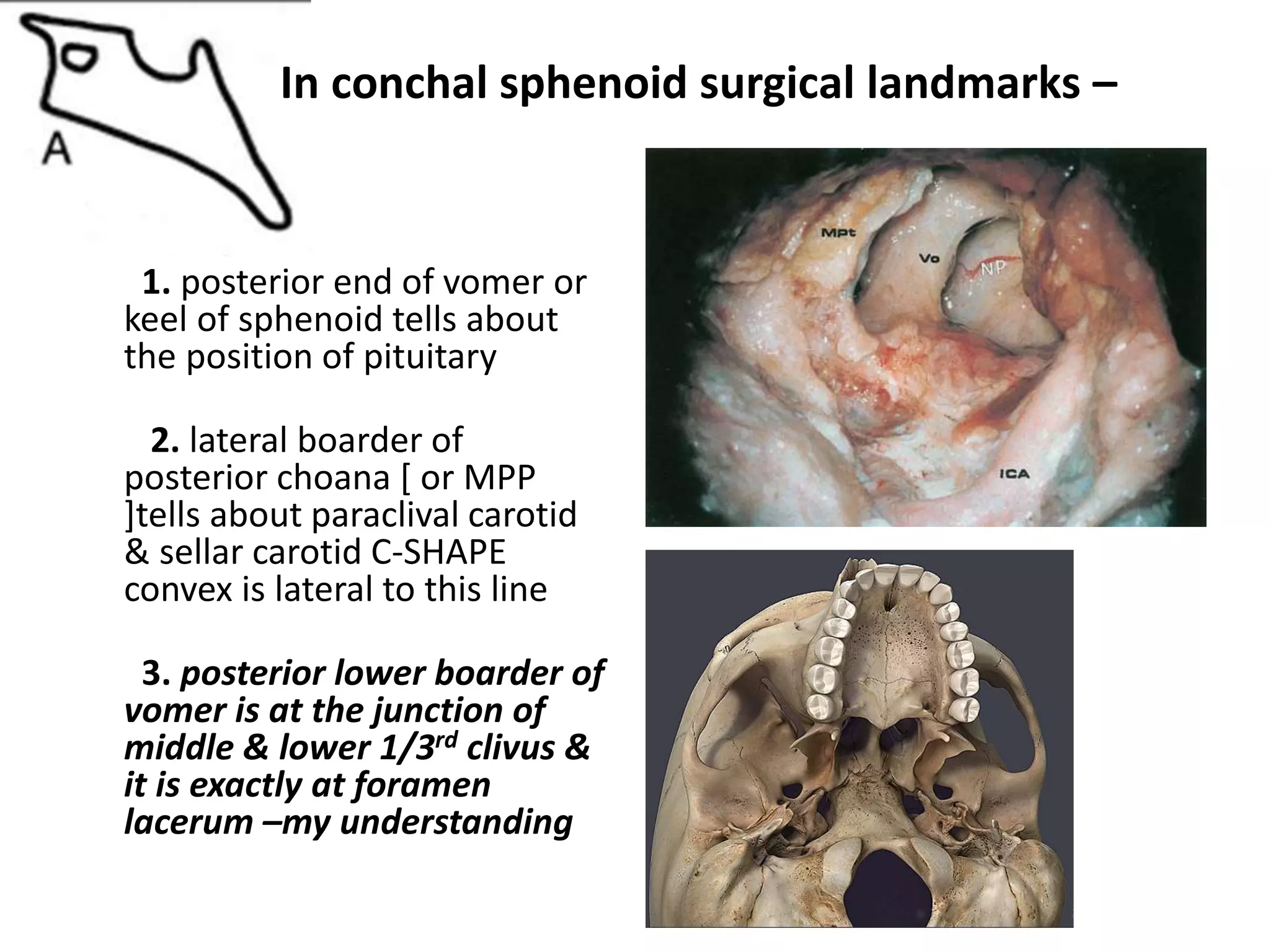 The “Ventral” Rule of Three - 3 turbinates codes to
upper,middle, lower Clivus ...
 
