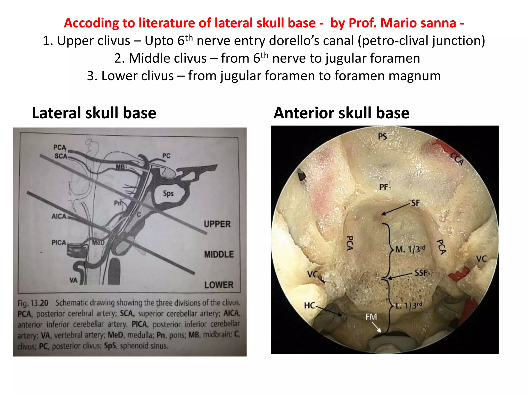 In conchal sphenoid surgical landmarks –
1. posterior end of vomer or
keel of sphenoid tells about
the position of pituitary
2. lateral boarder of
posterior choana [ or MPP
]tells about paraclival carotid
& sellar carotid C-SHAPE
convex is lateral to this line
3. posterior lower boarder of
vomer is at the junction of
middle & lower 1/3rd clivus &
it is exactly at foramen
lacerum –my understanding
 