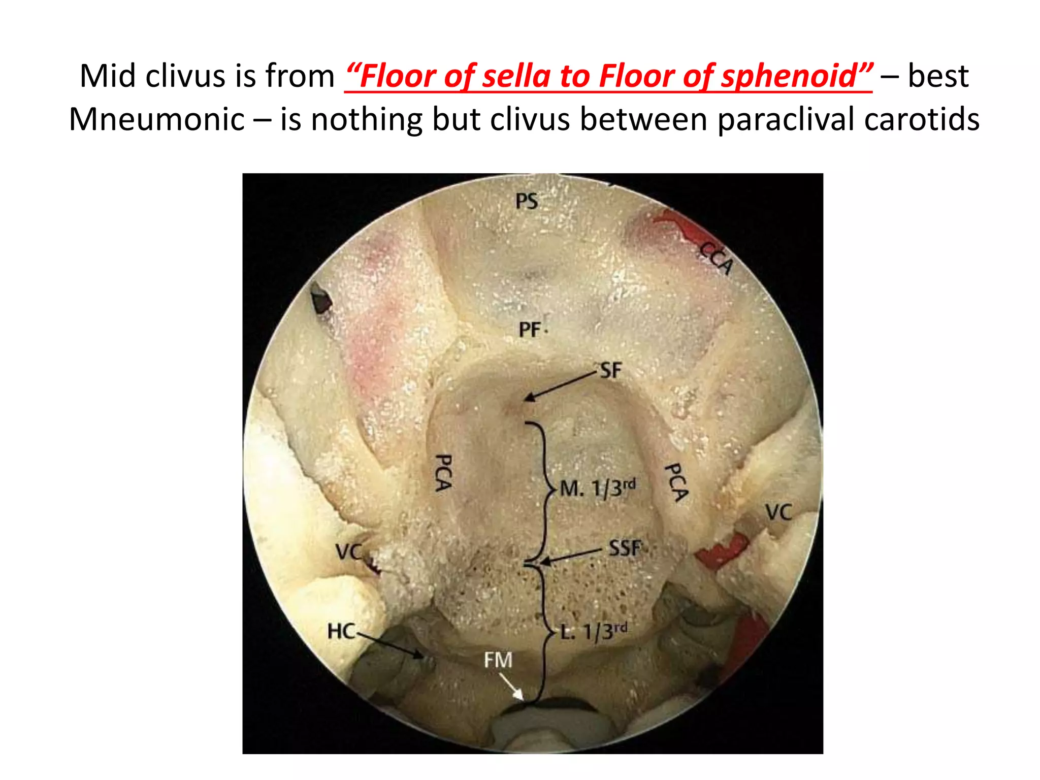 Accoding to literature of lateral skull base - by Prof. Mario sanna -
1. Upper clivus – Upto 6th nerve entry dorello’s canal (petro-clival junction)
2. Middle clivus – from 6th nerve to jugular foramen
3. Lower clivus – from jugular foramen to foramen magnum
Lateral skull base Anterior skull base
 