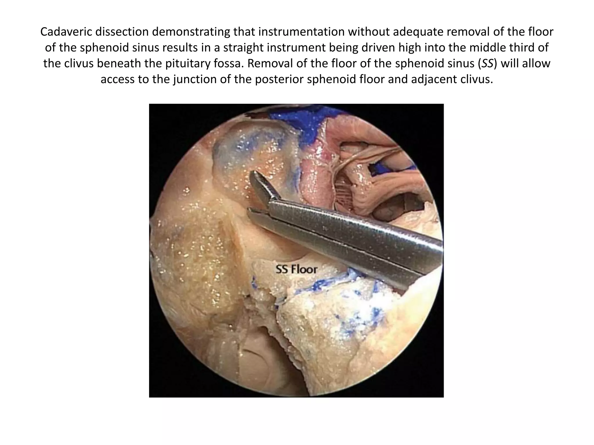 According to literature of anterior skull base –
The middle third clivus (M. 1/3rd) begins at the sella floor (SF) and extends to
the floor of the sphenoid sinus (SSF), and the lower third (L. 1/3rd) extends
from the floor of the sphenoid sinus to the foramen magnum (FM).
Lateral skull base Anterior skull base
 