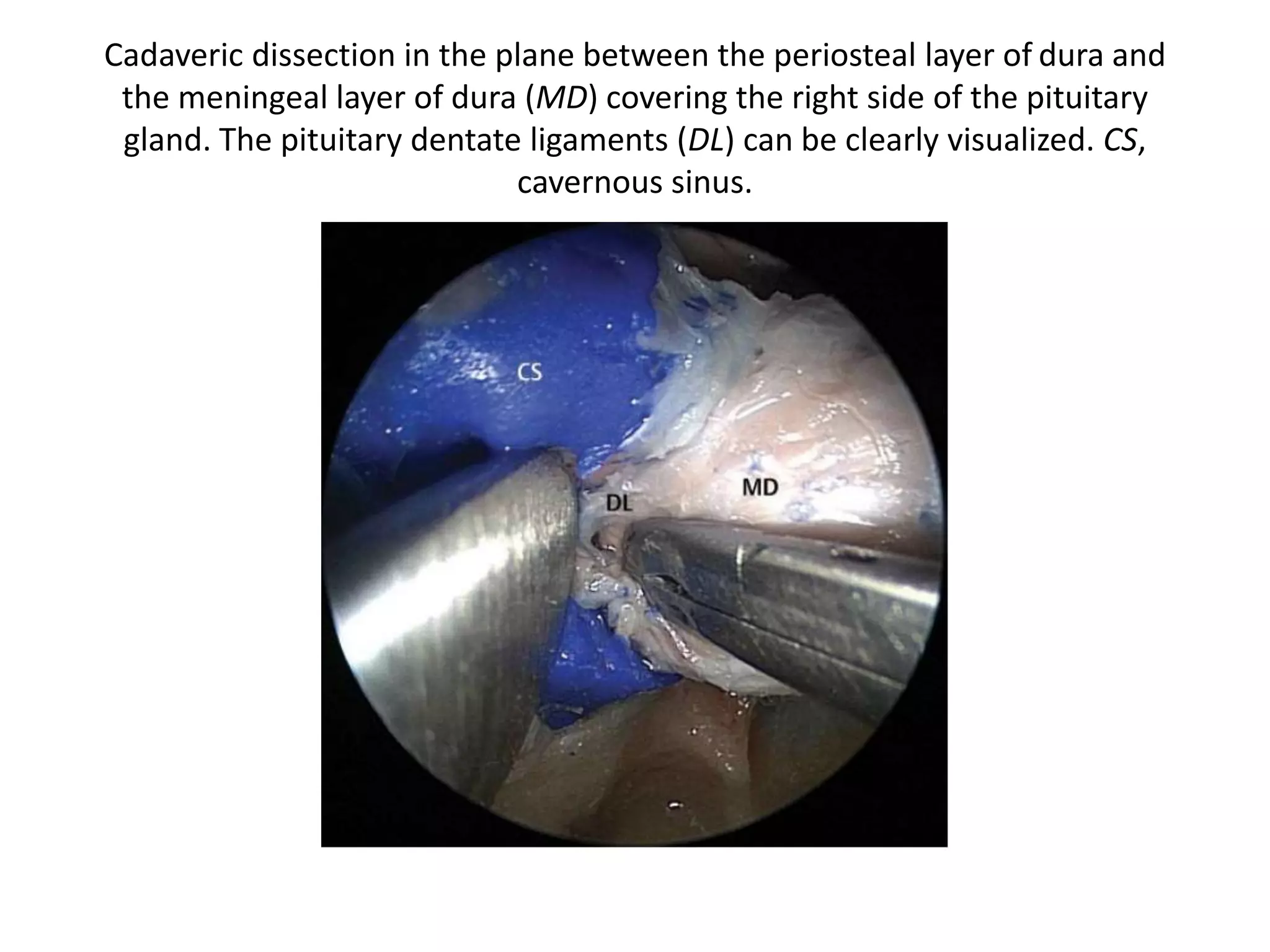 Mid clivus is from “Floor of sella to Floor of sphenoid” – best
Mneumonic – is nothing but clivus between paraclival carotids
 