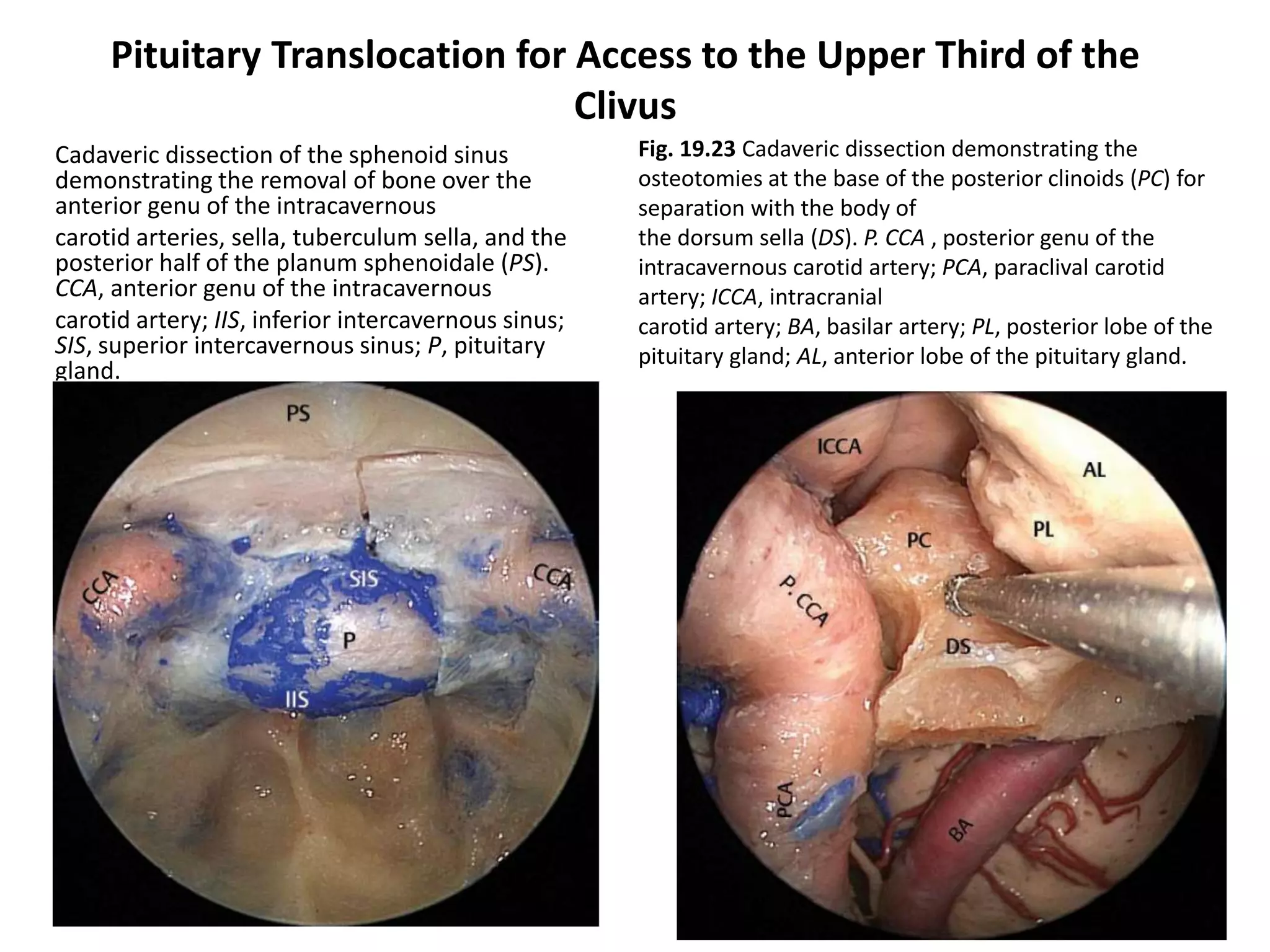 Cadaveric dissection demonstrating that instrumentation without adequate removal of the floor
of the sphenoid sinus results in a straight instrument being driven high into the middle third of
the clivus beneath the pituitary fossa. Removal of the floor of the sphenoid sinus (SS) will allow
access to the junction of the posterior sphenoid floor and adjacent clivus.
 