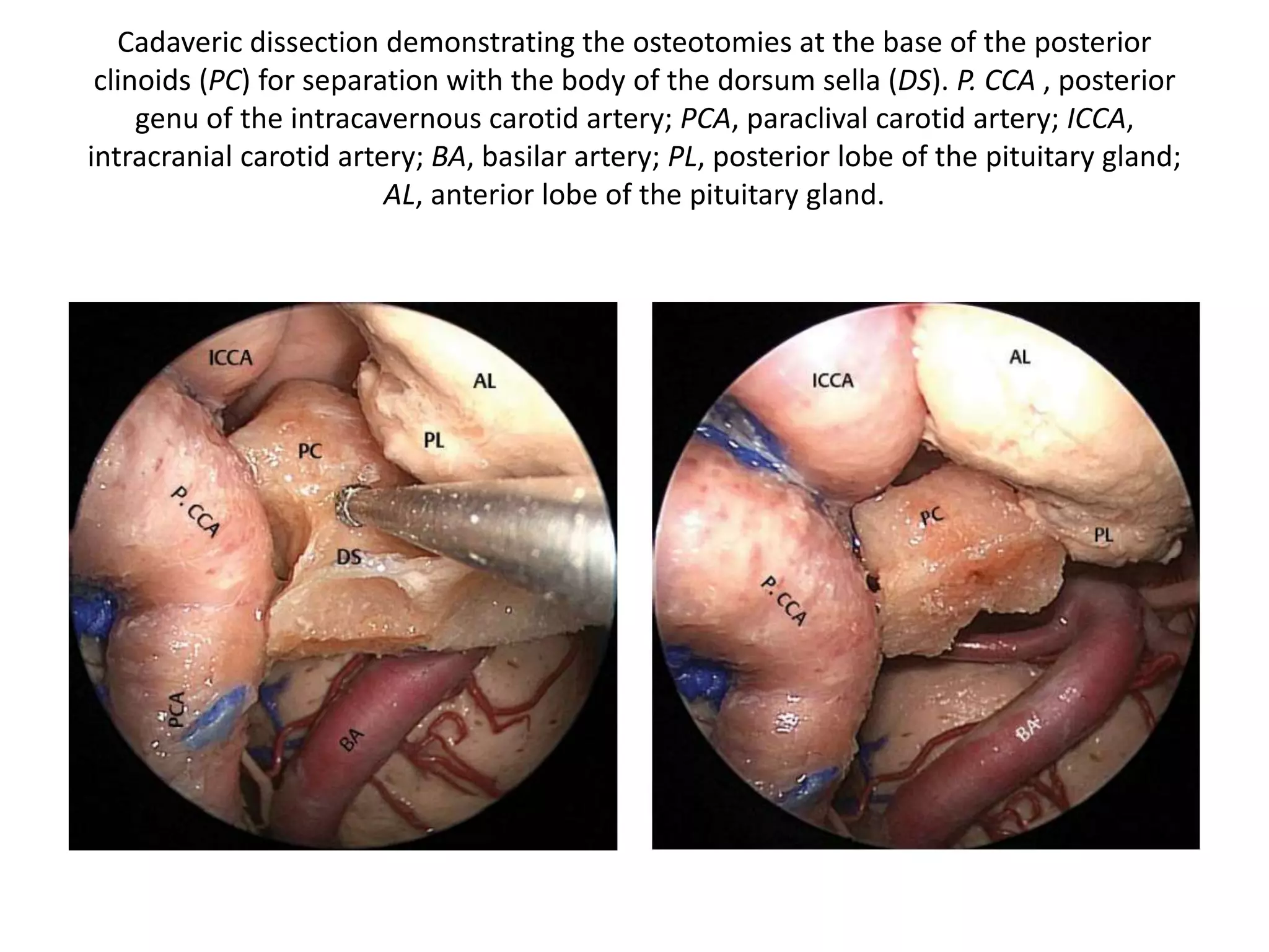 Cadaveric dissection in the plane between the periosteal layer of dura and
the meningeal layer of dura (MD) covering the right side of the pituitary
gland. The pituitary dentate ligaments (DL) can be clearly visualized. CS,
cavernous sinus.
 