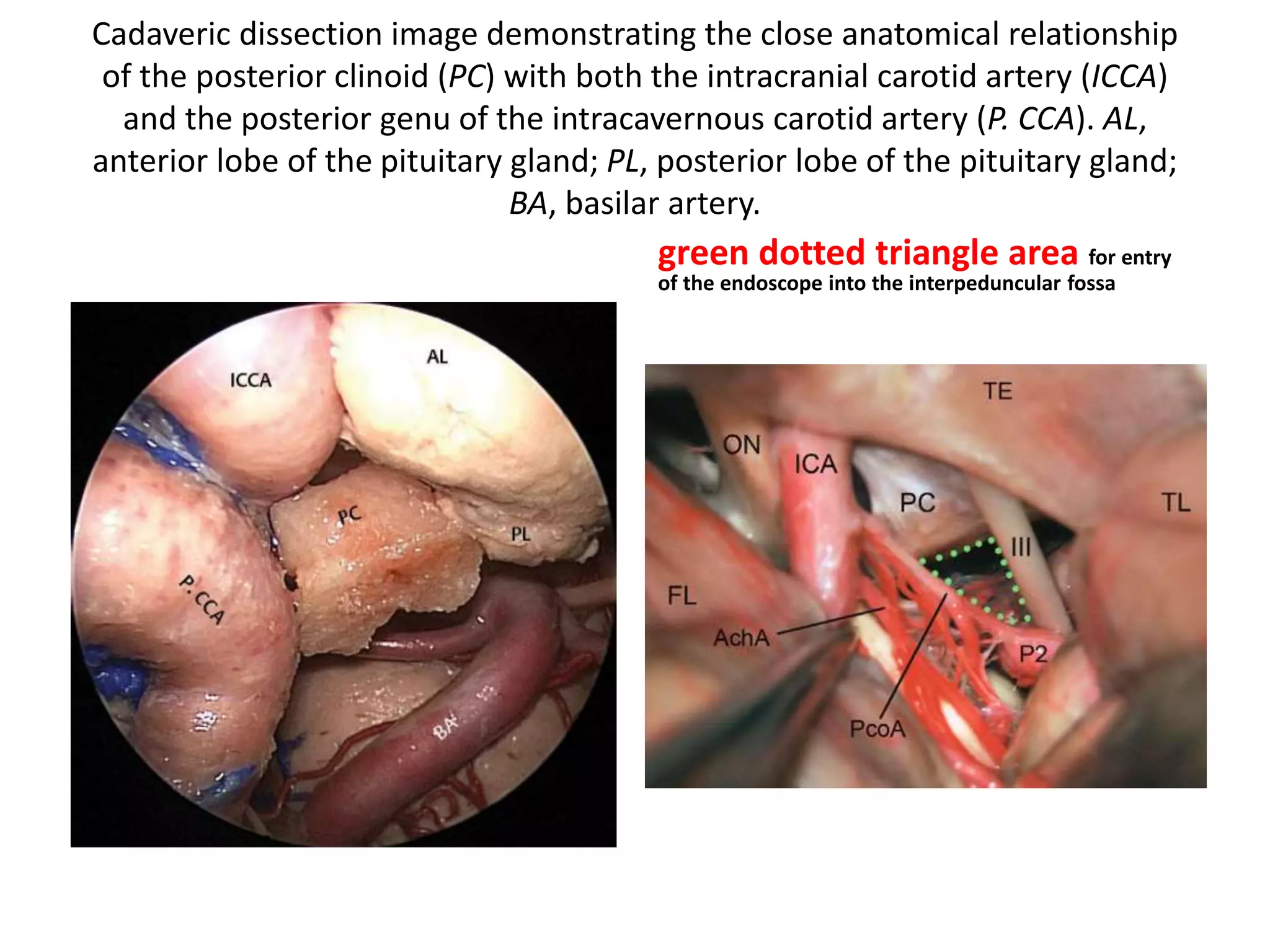 Pituitary Translocation for Access to the Upper Third of the
Clivus
Cadaveric dissection of the sphenoid sinus
demonstrating the removal of bone over the
anterior genu of the intracavernous
carotid arteries, sella, tuberculum sella, and the
posterior half of the planum sphenoidale (PS).
CCA, anterior genu of the intracavernous
carotid artery; IIS, inferior intercavernous sinus;
SIS, superior intercavernous sinus; P, pituitary
gland.
Fig. 19.23 Cadaveric dissection demonstrating the
osteotomies at the base of the posterior clinoids (PC) for
separation with the body of
the dorsum sella (DS). P. CCA , posterior genu of the
intracavernous carotid artery; PCA, paraclival carotid
artery; ICCA, intracranial
carotid artery; BA, basilar artery; PL, posterior lobe of the
pituitary gland; AL, anterior lobe of the pituitary gland.
 