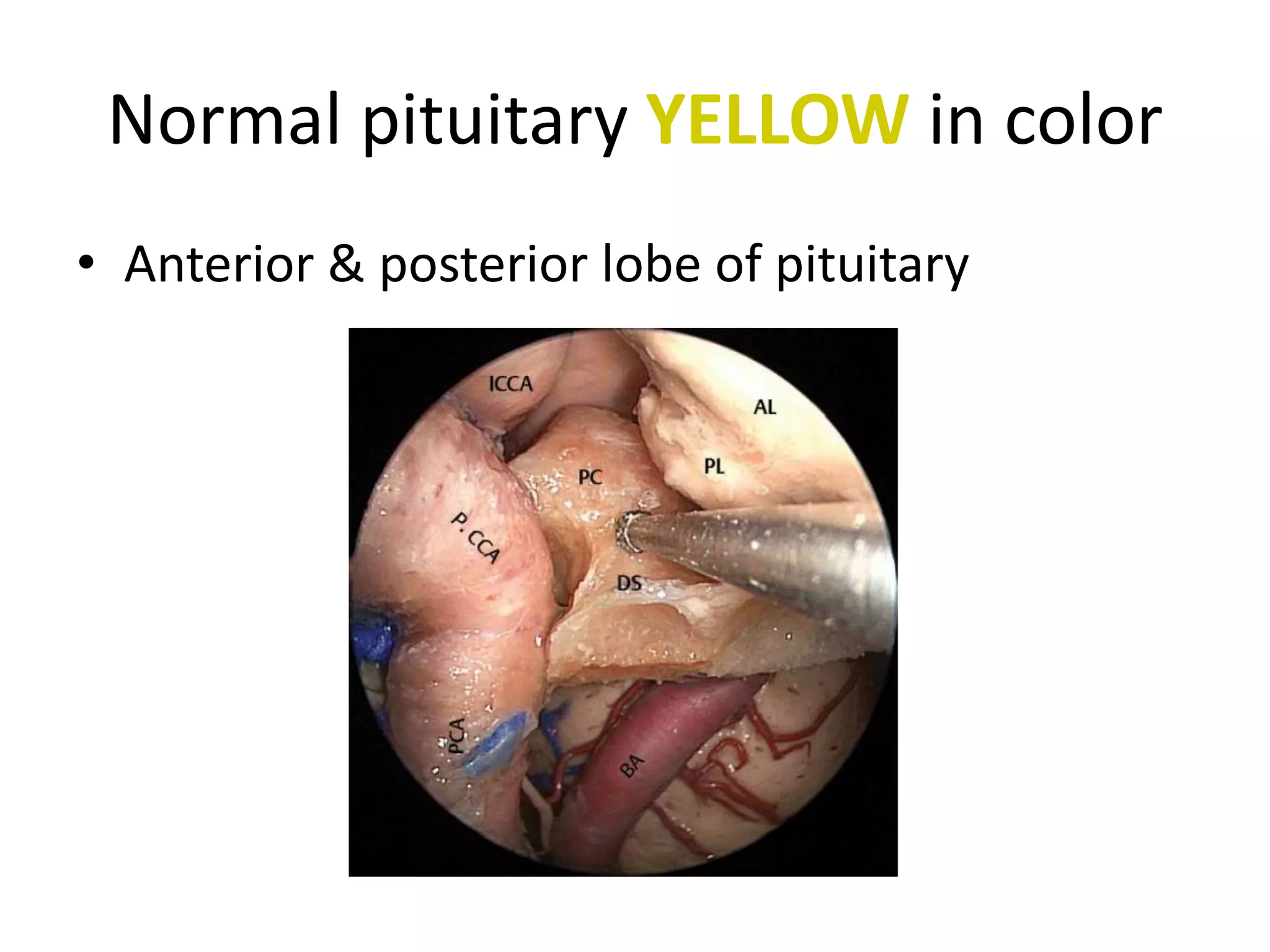Cadaveric dissection demonstrating the osteotomies at the base of the posterior
clinoids (PC) for separation with the body of the dorsum sella (DS). P. CCA , posterior
genu of the intracavernous carotid artery; PCA, paraclival carotid artery; ICCA,
intracranial carotid artery; BA, basilar artery; PL, posterior lobe of the pituitary gland;
AL, anterior lobe of the pituitary gland.
 
