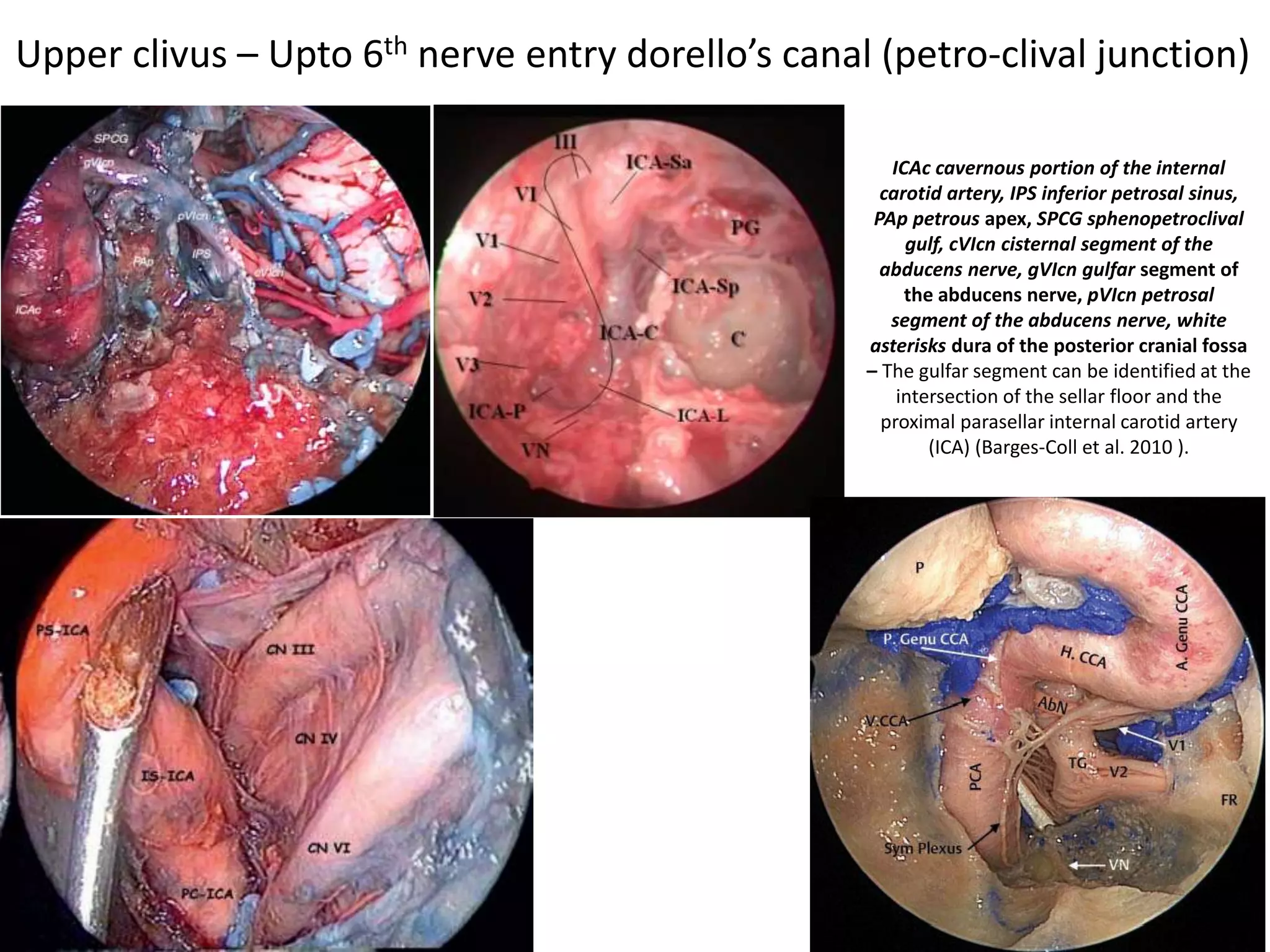 Cadaveric dissection image demonstrating the close anatomical relationship
of the posterior clinoid (PC) with both the intracranial carotid artery (ICCA)
and the posterior genu of the intracavernous carotid artery (P. CCA). AL,
anterior lobe of the pituitary gland; PL, posterior lobe of the pituitary gland;
BA, basilar artery.
green dotted triangle area for entry
of the endoscope into the interpeduncular fossa
 