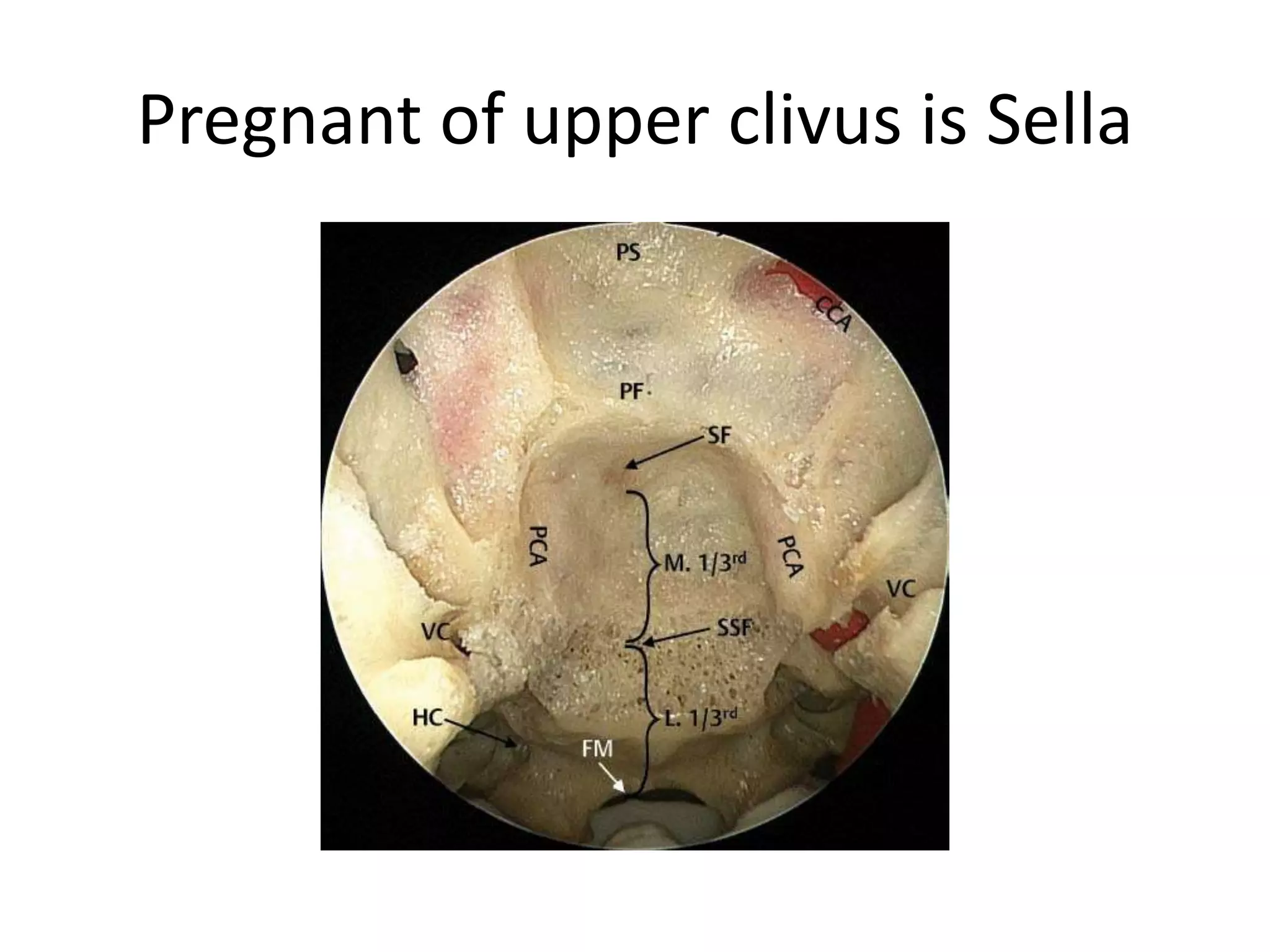 ICAc cavernous portion of the internal
carotid artery, IPS inferior petrosal sinus,
PAp petrous apex, SPCG sphenopetroclival
gulf, cVIcn cisternal segment of the
abducens nerve, gVIcn gulfar segment of
the abducens nerve, pVIcn petrosal
segment of the abducens nerve, white
asterisks dura of the posterior cranial fossa
– The gulfar segment can be identified at the
intersection of the sellar floor and the
proximal parasellar internal carotid artery
(ICA) (Barges-Coll et al. 2010 ).
Upper clivus – Upto 6th nerve entry dorello’s canal (petro-clival junction)
 