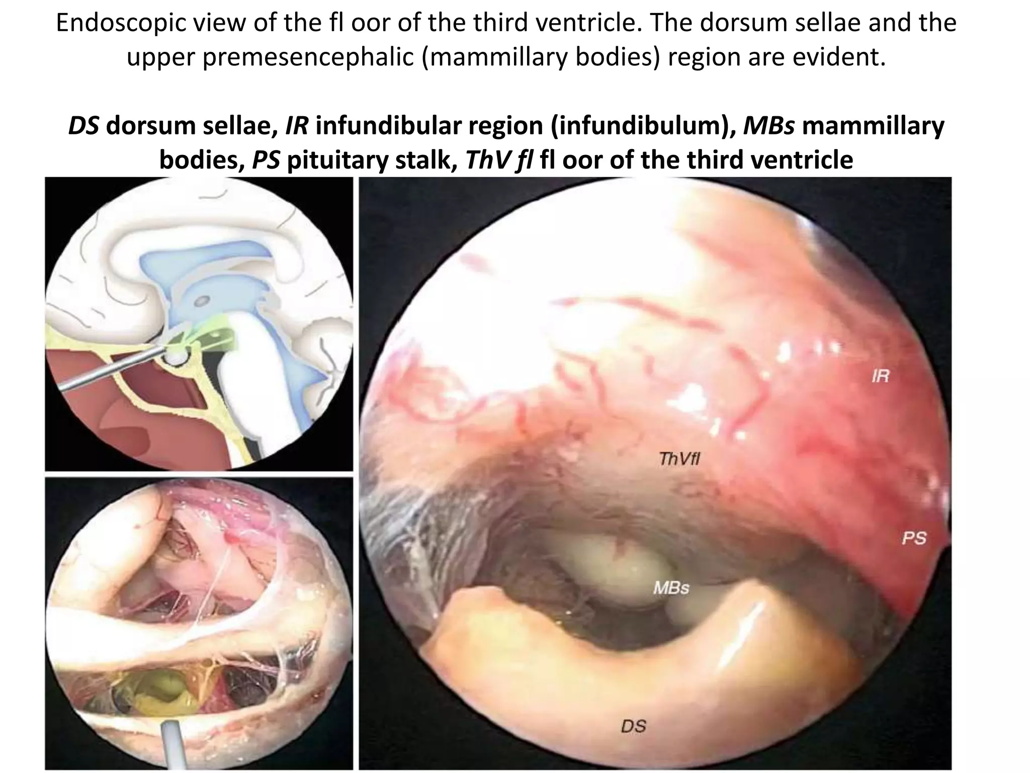 1. 6th N. crossing carotid at Petro-clival junction when viewing in lateral skull base - The
lateral aspect of the parasellar & paraclival carotid junction is crossed by the
abducent nerve (VI) at the entrance of both [ 6th nerve & carotid ] structures into the
cavernous sinus.
2. The gulfar segment can be identified at the intersection of the sellar floor and the
proximal parasellar internal carotid artery (ICA) (Barges-Coll et al. 2010 ).
 