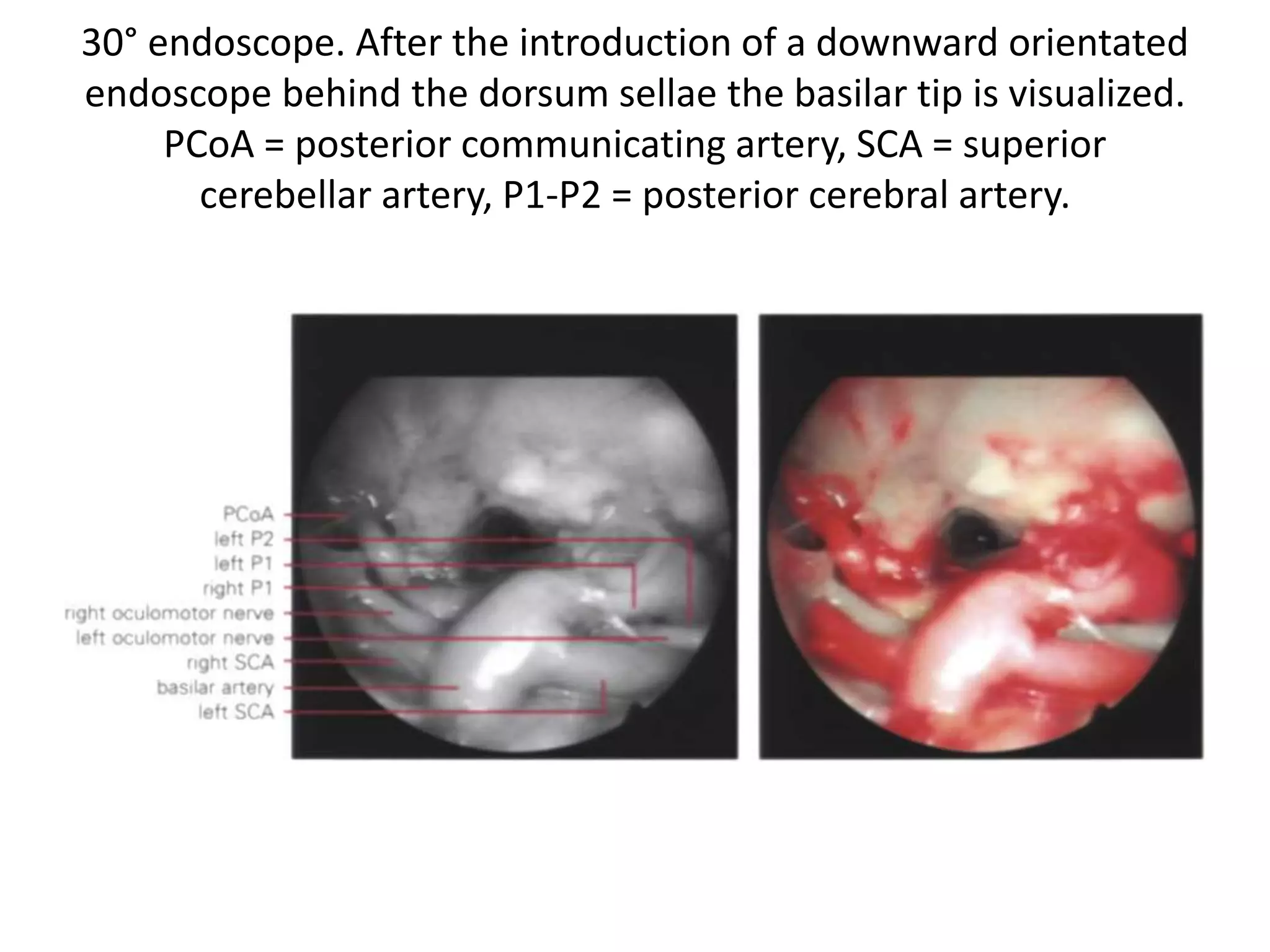 Endoscopic view of the fl oor of the third ventricle. The dorsum sellae and the
upper premesencephalic (mammillary bodies) region are evident.
DS dorsum sellae, IR infundibular region (infundibulum), MBs mammillary
bodies, PS pituitary stalk, ThV fl fl oor of the third ventricle
 