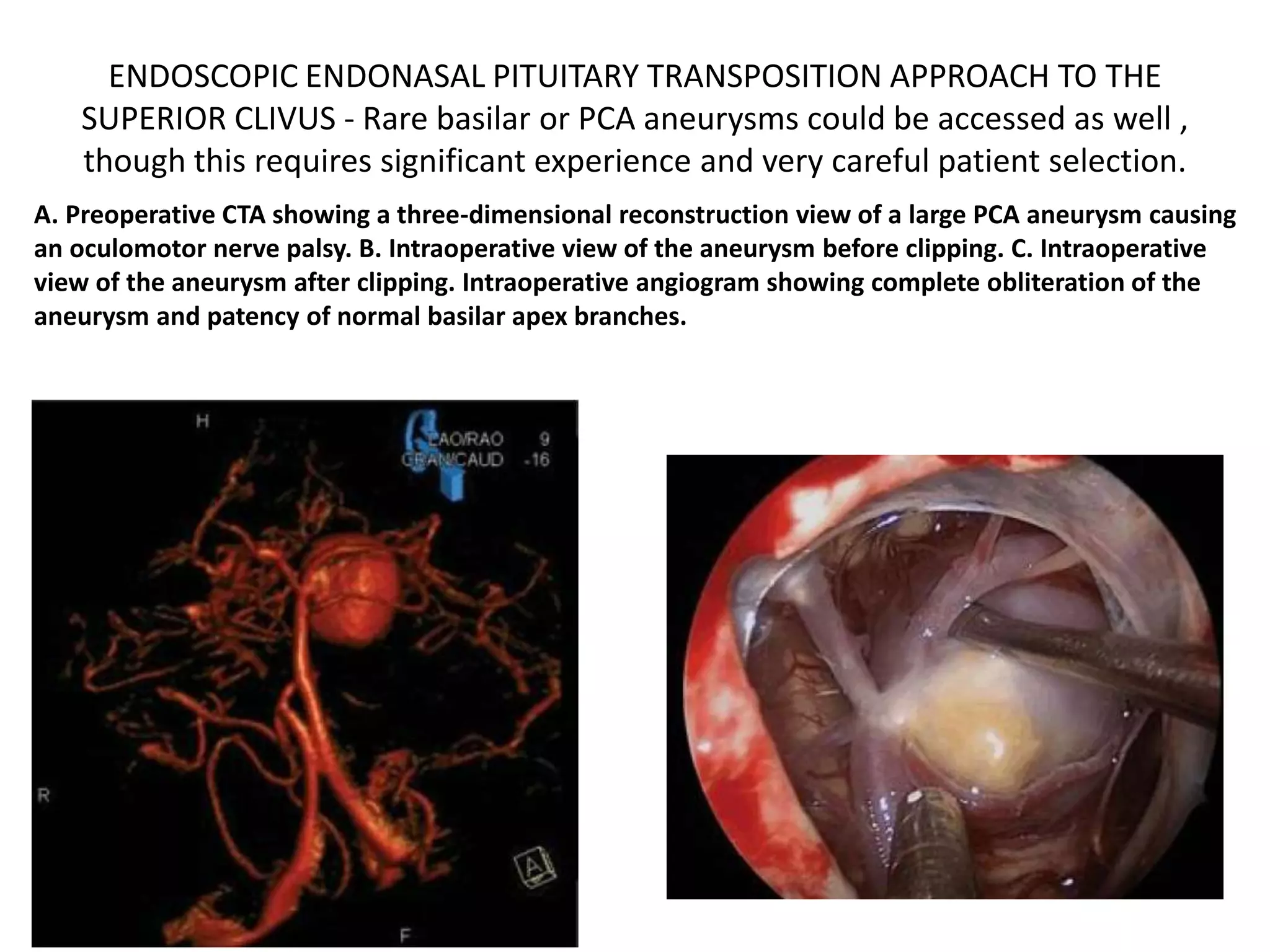 30° endoscope. Right side. closer view. PCoA =
posterior communicating artery. SCA = superior
cerebellar artery. P1 = posterior cerebral artery.
 