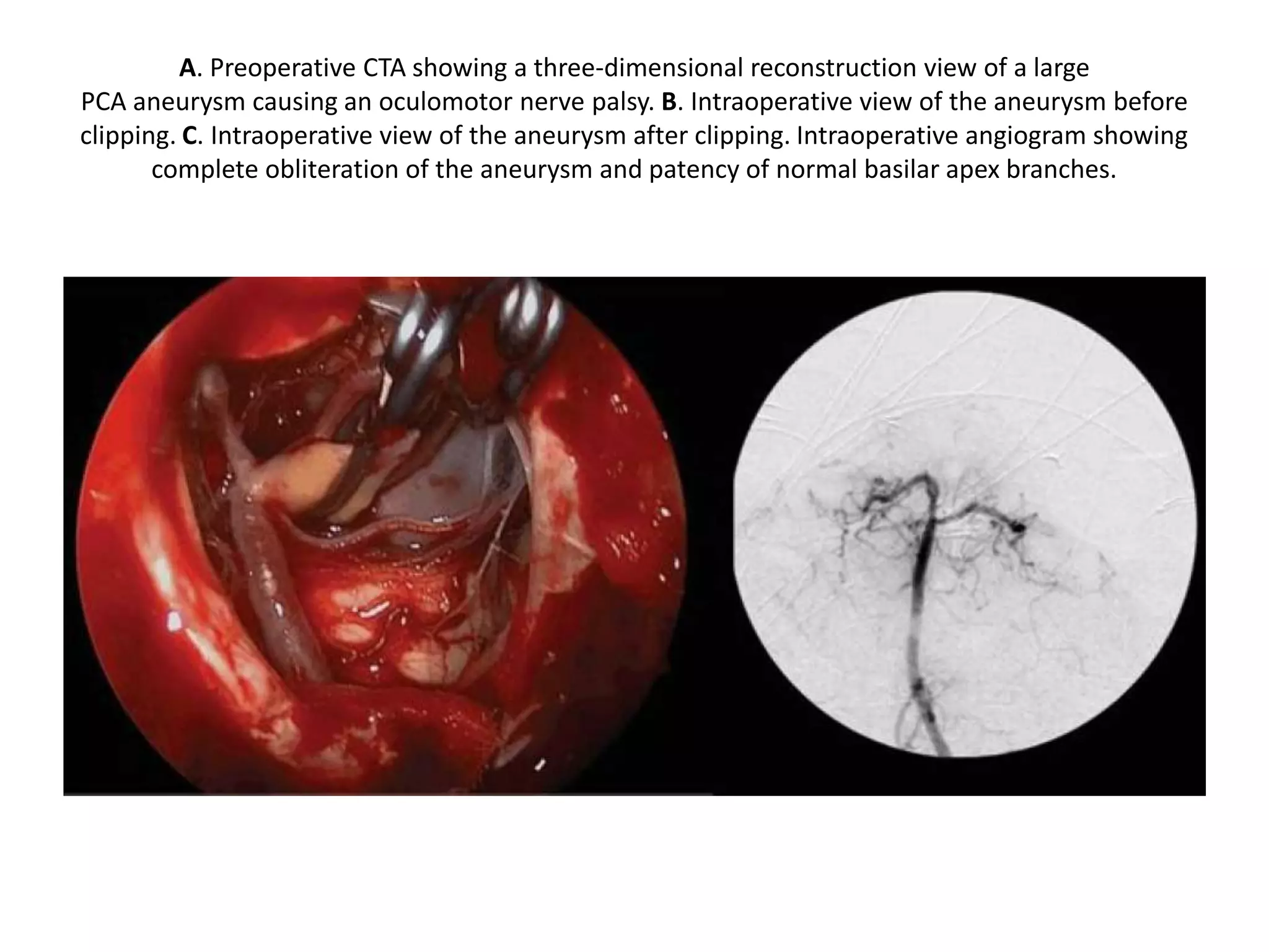 30° endoscope. Left side. closer view. SCA = superior
cerebellar artery. P1-P2 = posterior cerebral artery.
PCoA = posterior communicating artery.
 