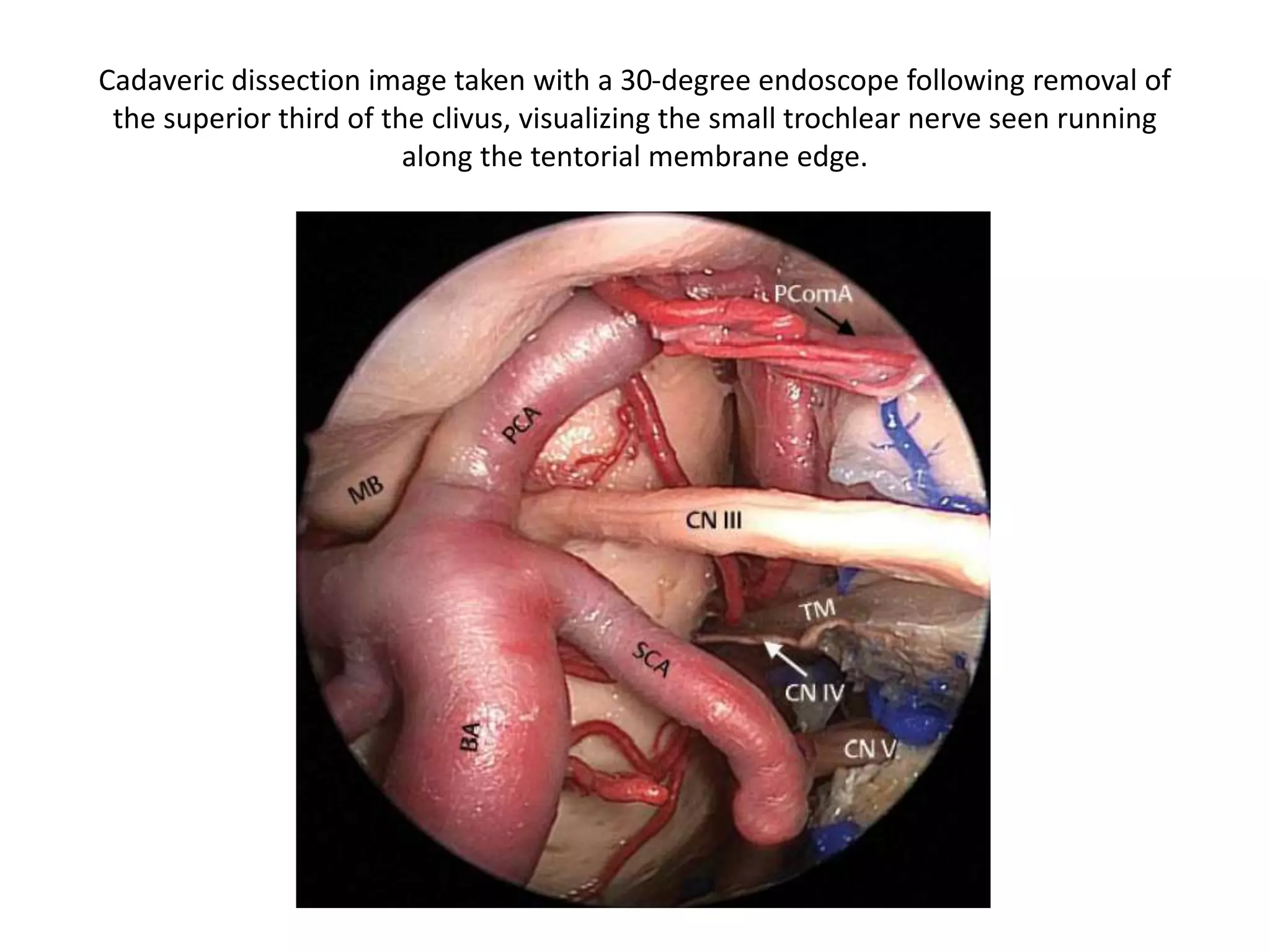 ENDOSCOPIC ENDONASAL PITUITARY TRANSPOSITION APPROACH TO THE
SUPERIOR CLIVUS - Rare basilar or PCA aneurysms could be accessed as well ,
though this requires significant experience and very careful patient selection.
A. Preoperative CTA showing a three-dimensional reconstruction view of a large PCA aneurysm causing
an oculomotor nerve palsy. B. Intraoperative view of the aneurysm before clipping. C. Intraoperative
view of the aneurysm after clipping. Intraoperative angiogram showing complete obliteration of the
aneurysm and patency of normal basilar apex branches.
 