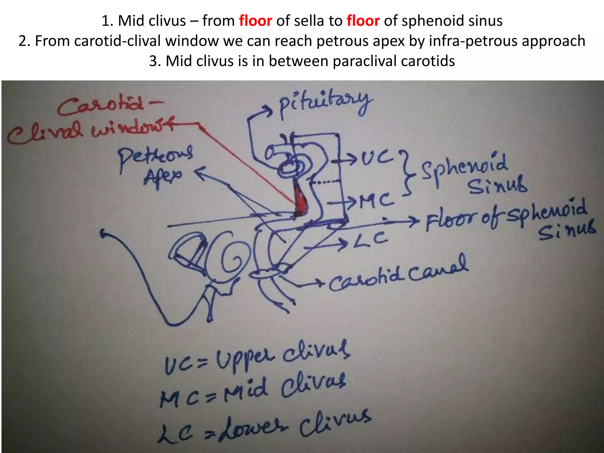 Pituitary transposition (Upper
clivus): Take special care to identify
and preserve the
superior hypophyseal arteries.
(SHA)
Extradural:
Dissect the pituitary gland from the
remainingsellar floor and posterior
wall.
Lift the pituitary gland, expose and
drill out theposterior clinoids.
Intradural:
Open the sellar dura anteriorly and
dissect the dura from the tunica.
Transect the ligaments that join
these two layers and the inferior
hypophyseal arteries. Divide the
diahragm exposing the stalk of the
pituitary.Transpose the gland
superiorly over the chiasm.
 