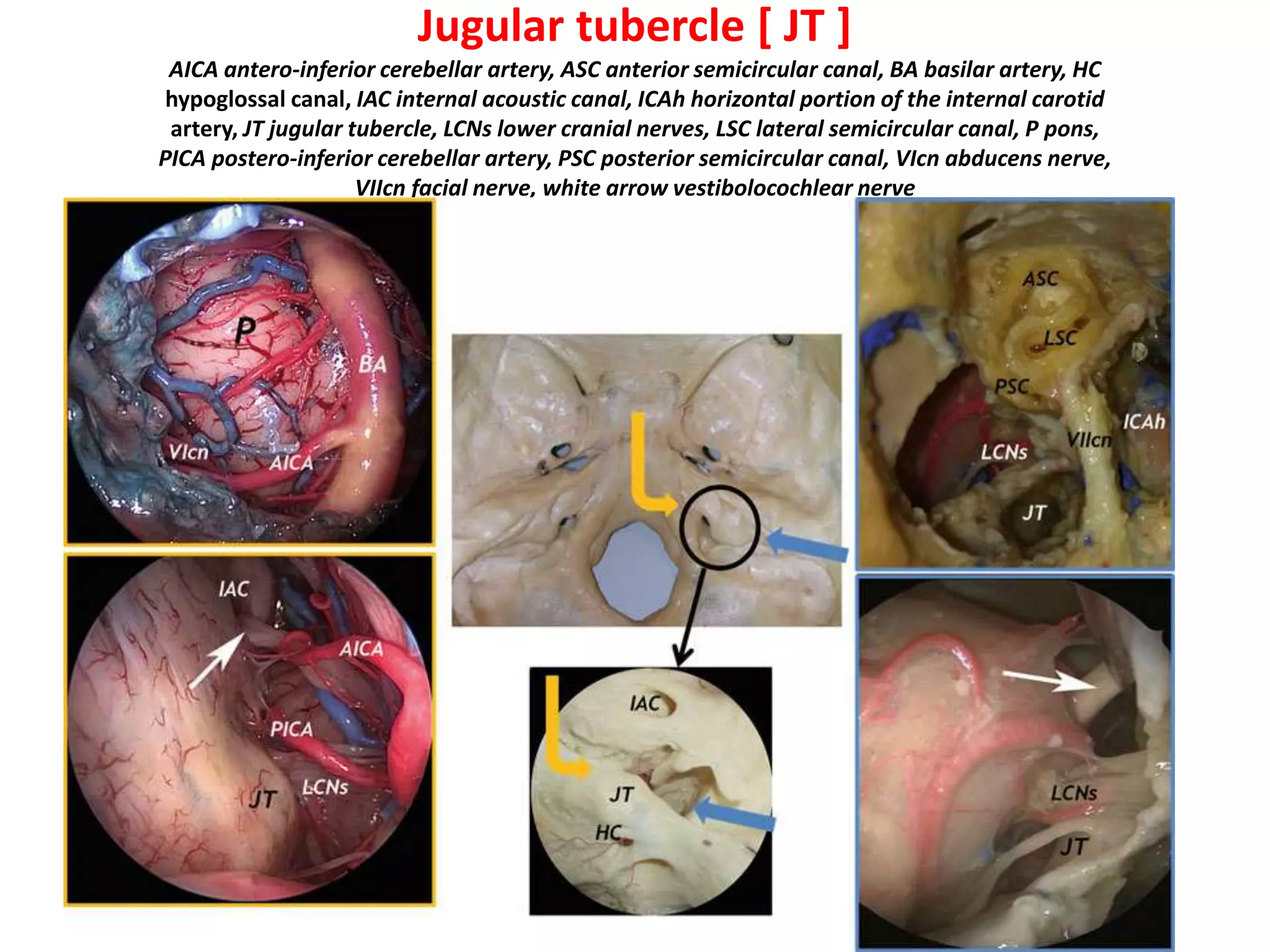 Lower half of paraclival carotid - caudal part, the lacerum segment of
the paraclival carotid
”The unsolved surgical problem remains the medial wall of the ICA at the level of the
anterior foramen lacerum, until now unreachable with the available surgical
approaches." - In lateral skull base by Prof. Mario sanna – this unreachable is Carotid-
Clival window which is accessable in Anterior skull base
Infrapetrous Approach
Carotid-Clival window – Mid clivus
a. Petrosal face
b.Clival face
 