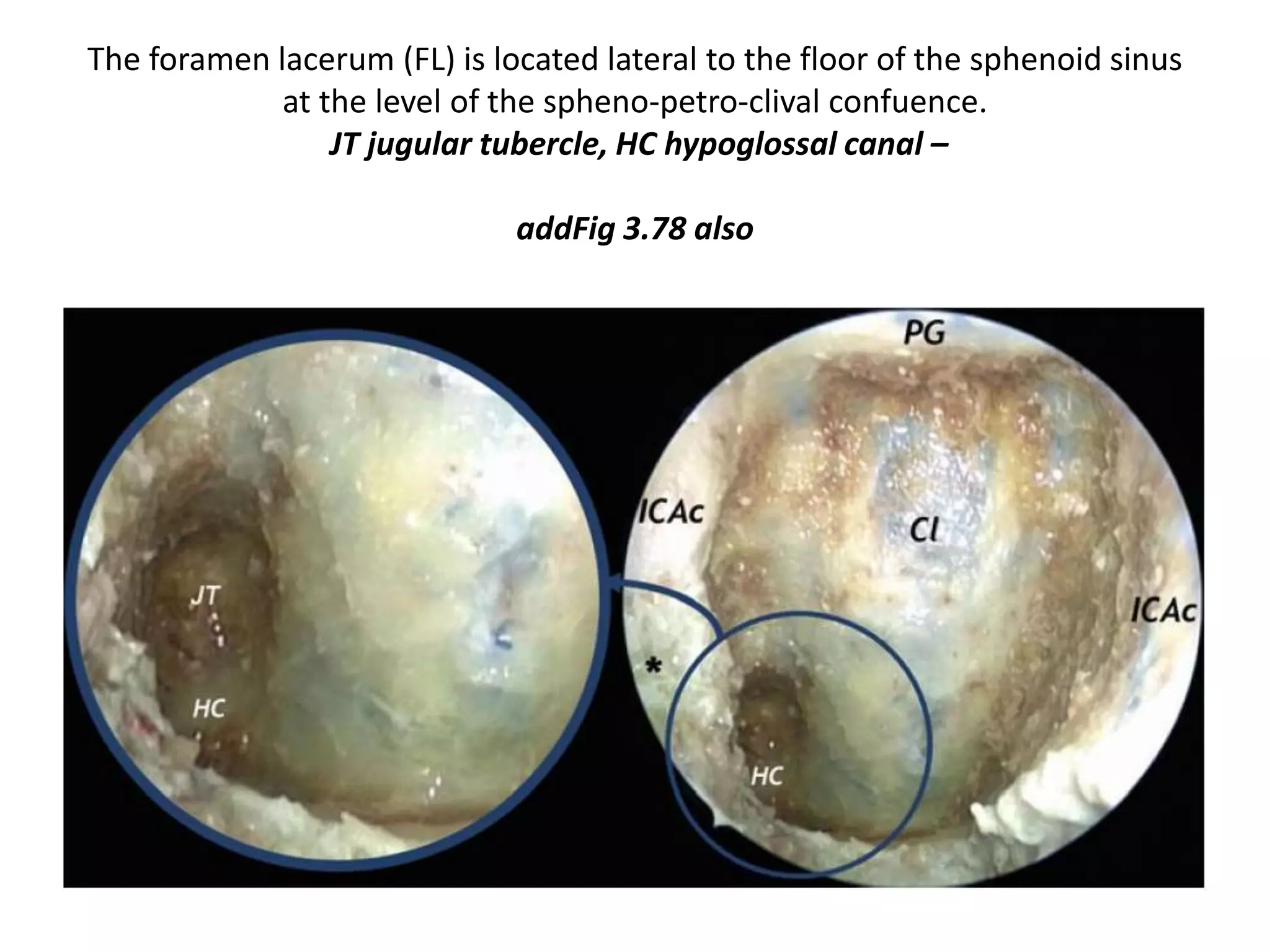 1. Mid clivus – from floor of sella to floor of sphenoid sinus
2. From carotid-clival window we can reach petrous apex by infra-petrous approach
3. Mid clivus is in between paraclival carotids
 