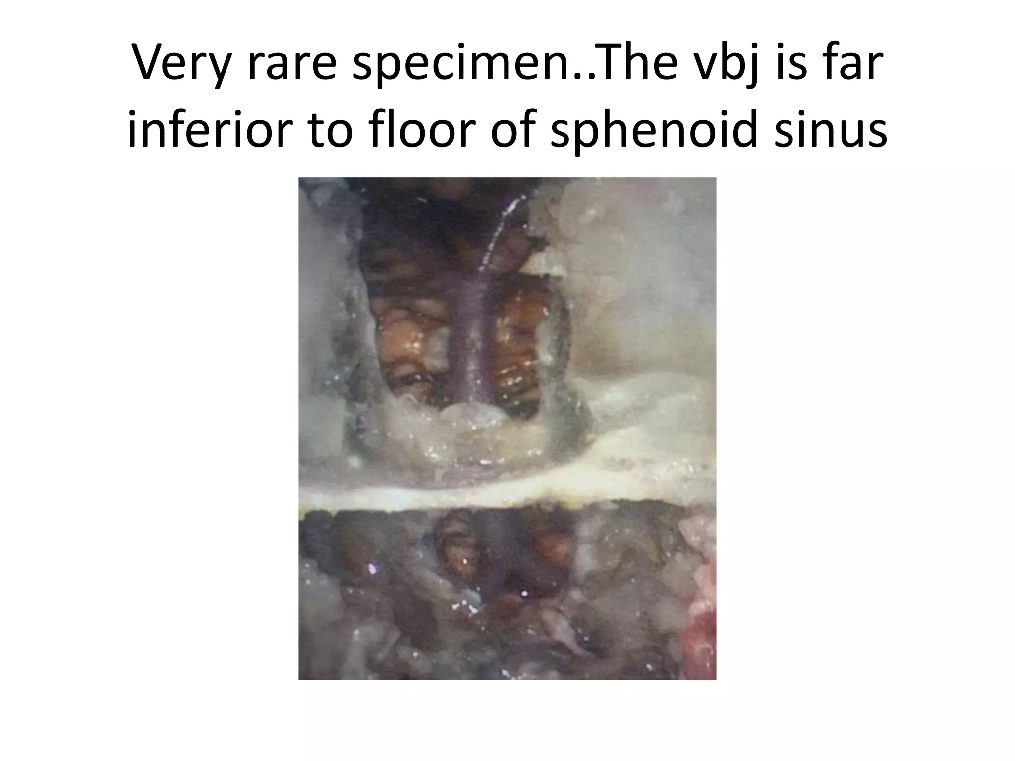 1. Mid clivus – from floor of sella to floor of sphenoid sinus
2. From carotid-clival window we can reach petrous apex by infra-petrous approach
3. Mid clivus is in between paraclival carotids
 
