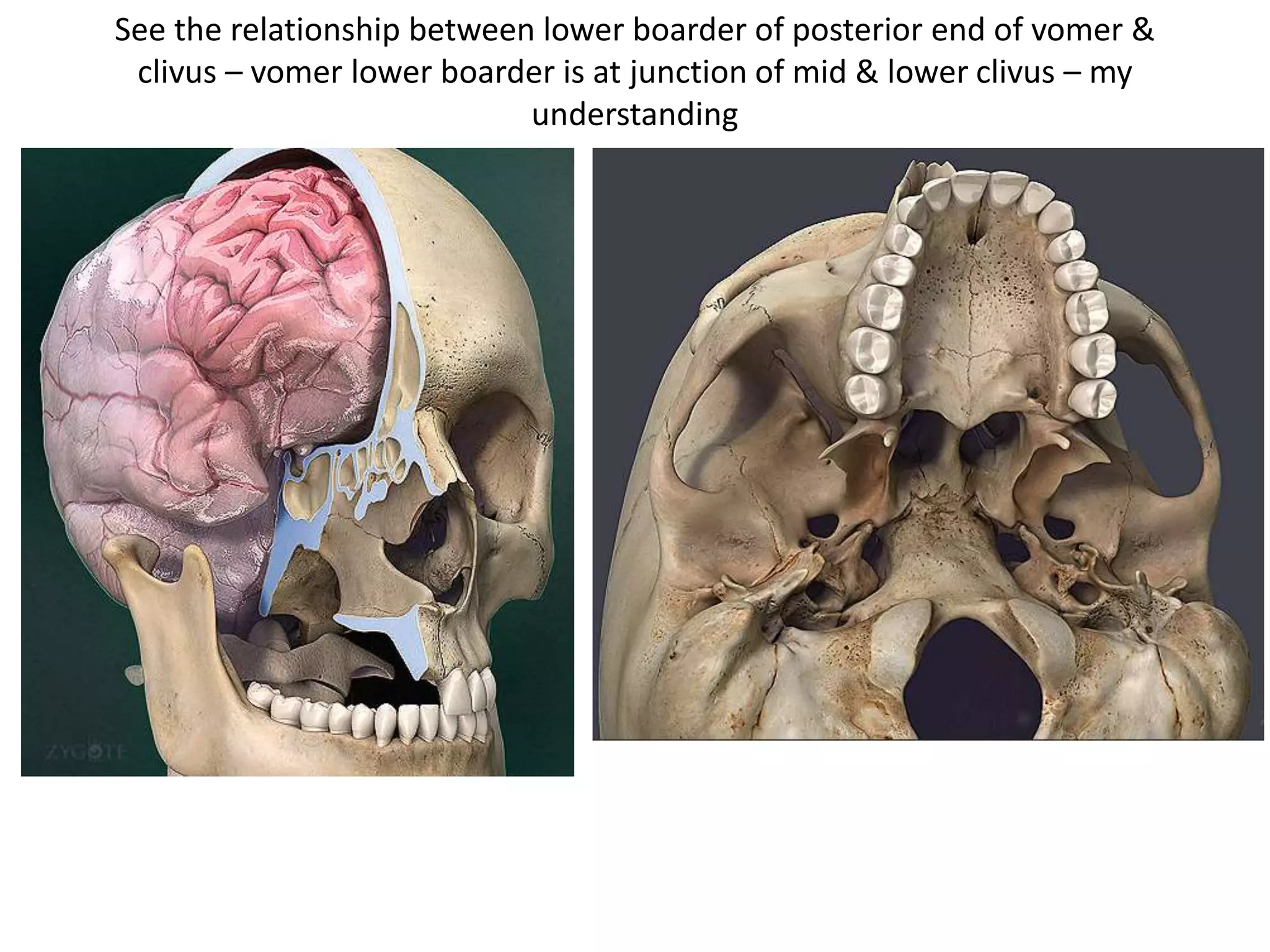 The foramen lacerum (FL) is located lateral to the floor of the sphenoid sinus
at the level of the spheno-petro-clival confuence.
JT jugular tubercle, HC hypoglossal canal –
addFig 3.78 also
 