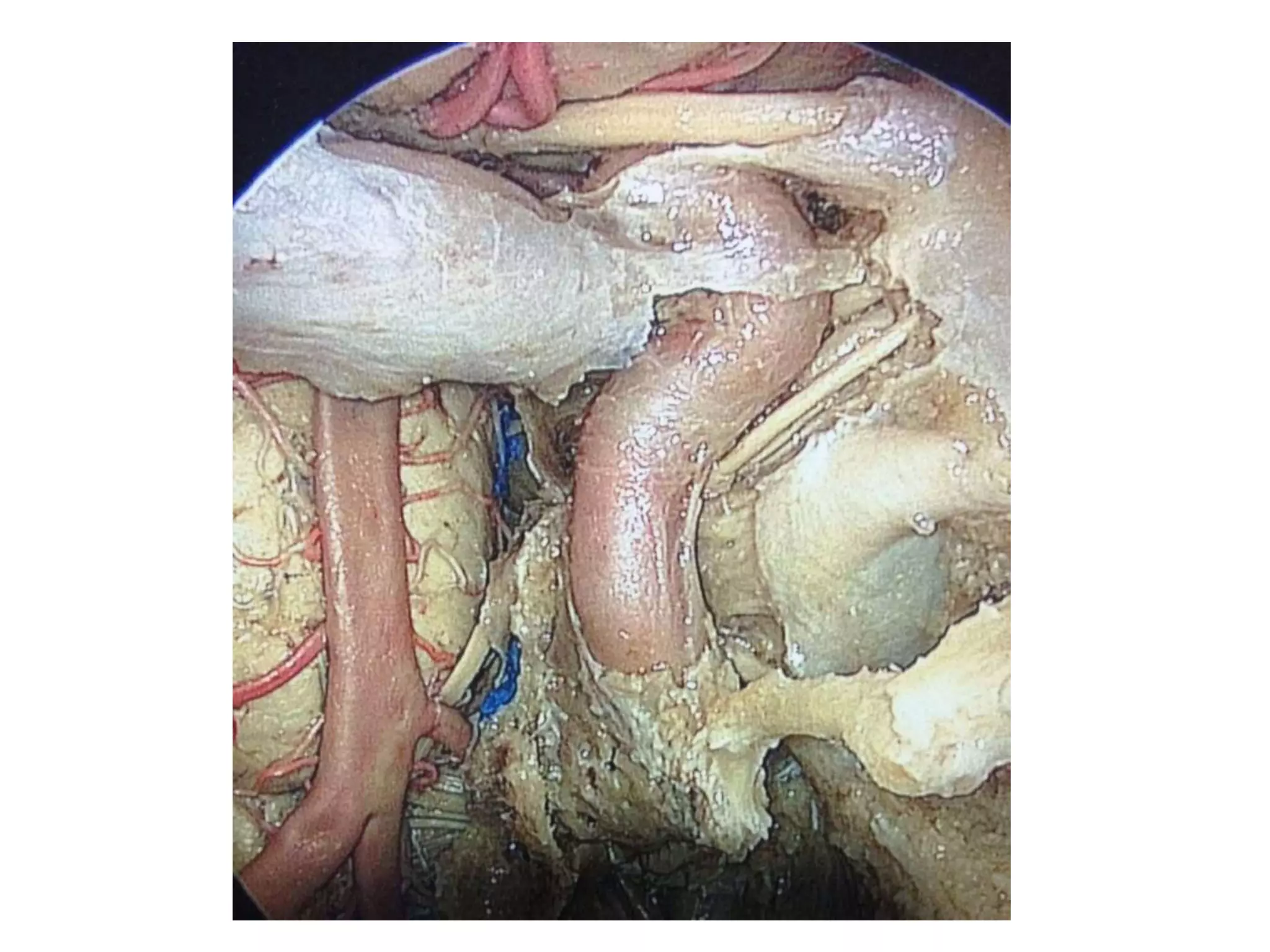 Very rare specimen..The vbj is far
inferior to floor of sphenoid sinus
 