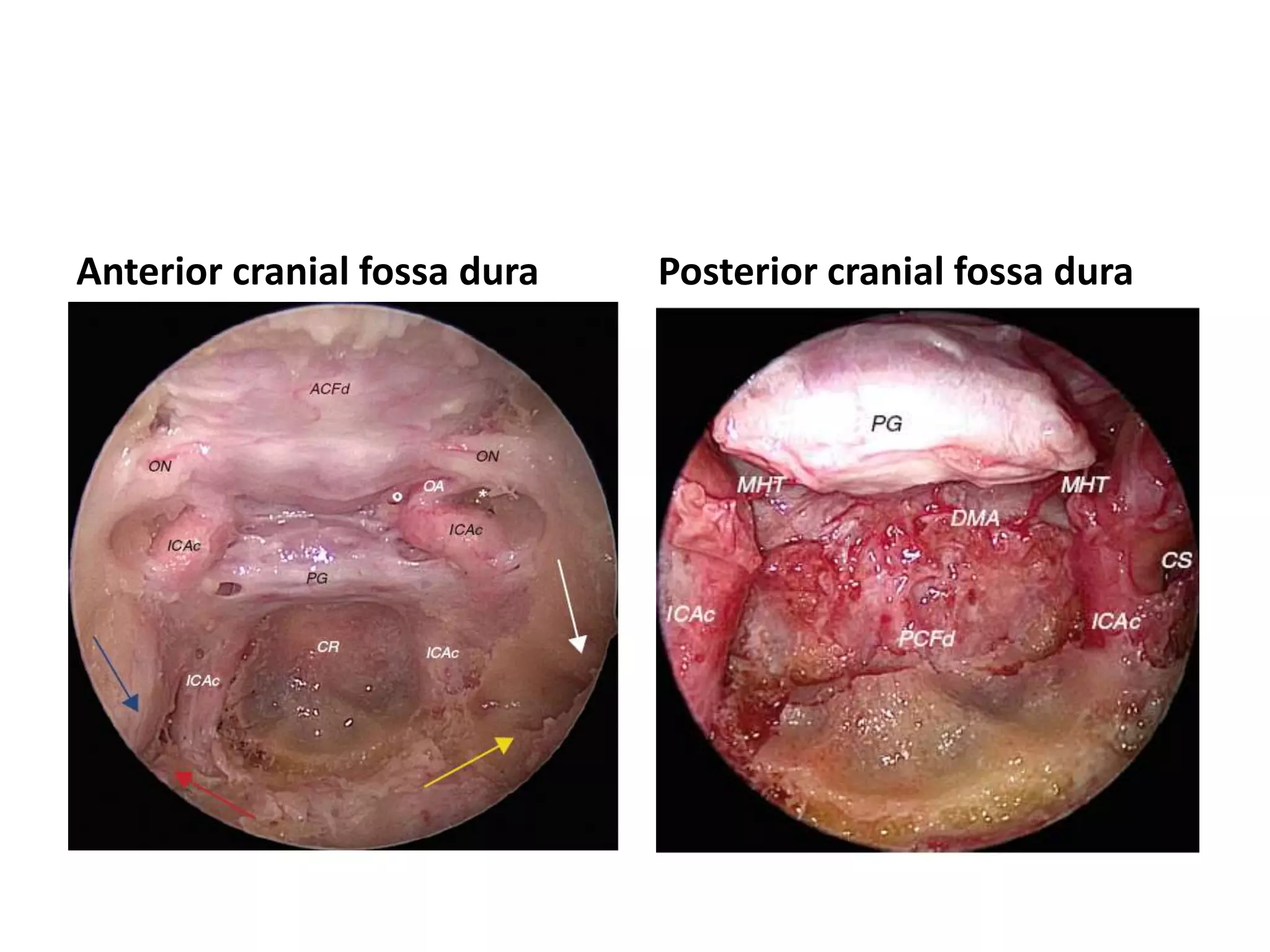 Cadaveric dissection of the middle third of the clivus with removal of the basilar
plexus and exposing the dura. The abducens
nerves (CN VI) can be seen bilaterally as they perforate the meningeal dura and
become the interdural segments of CN VI. CS,
cavernous sinus; PCA, paraclival carotid arteries; P, pituitary gland.
 