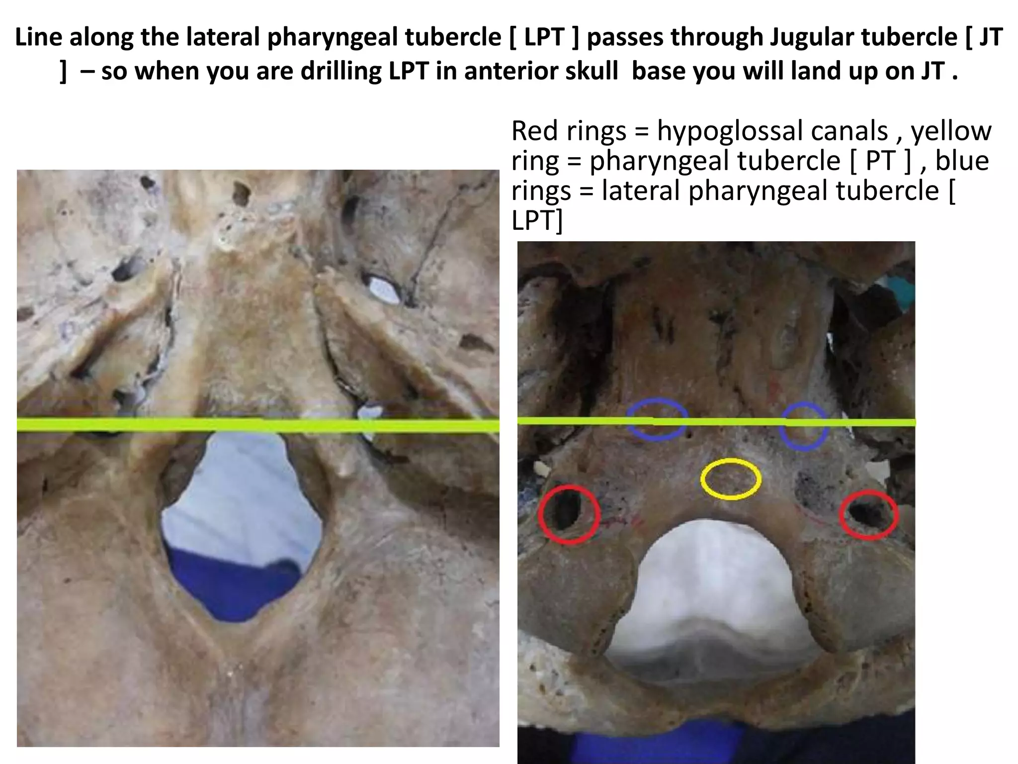 Anterior cranial fossa dura Posterior cranial fossa dura
 