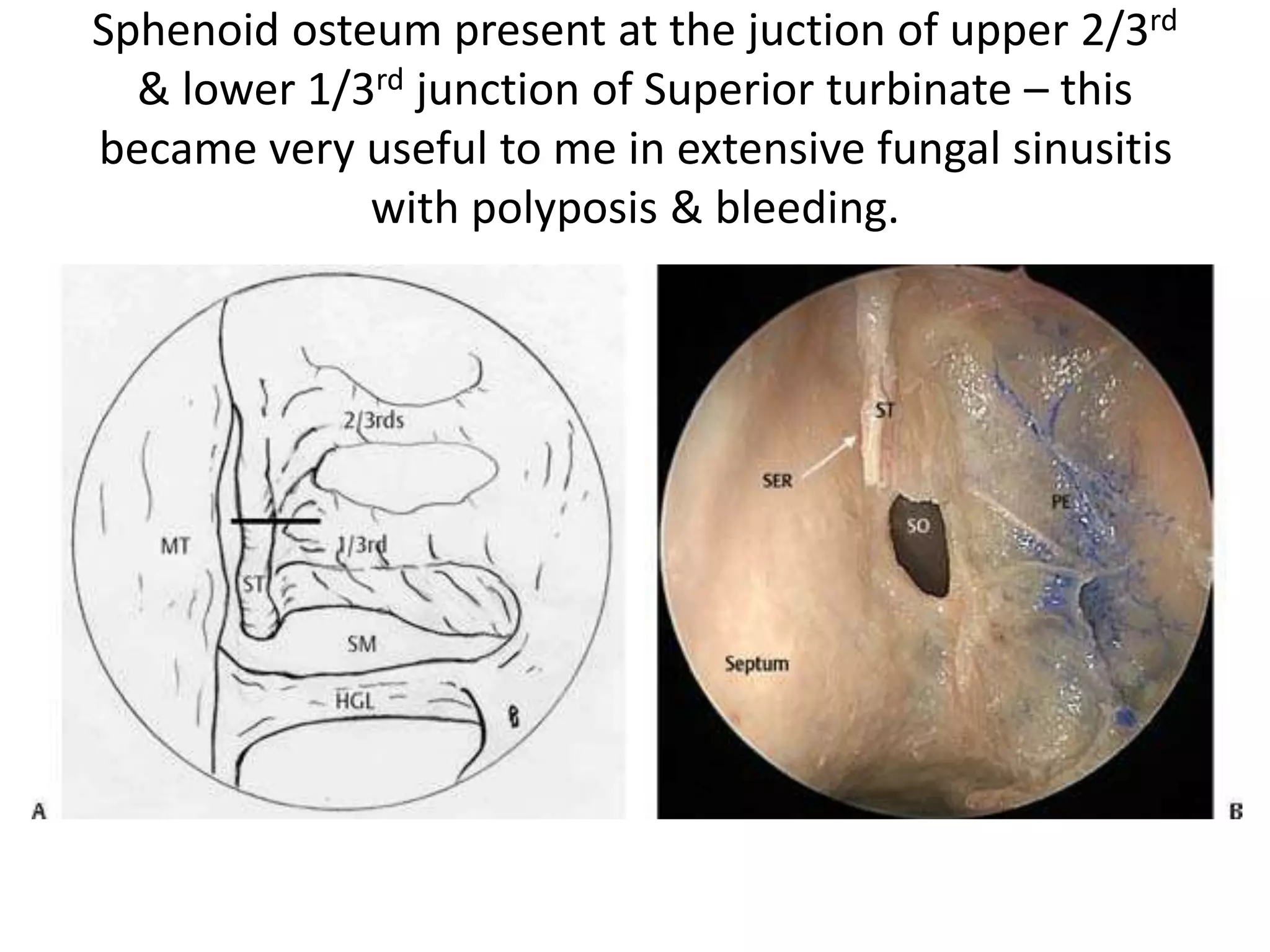 Sphenoid osteum present at the juction of upper 2/3rd
& lower 1/3rd junction of Superior turbinate – this
became very useful to me in extensive fungal sinusitis
with polyposis & bleeding.
 