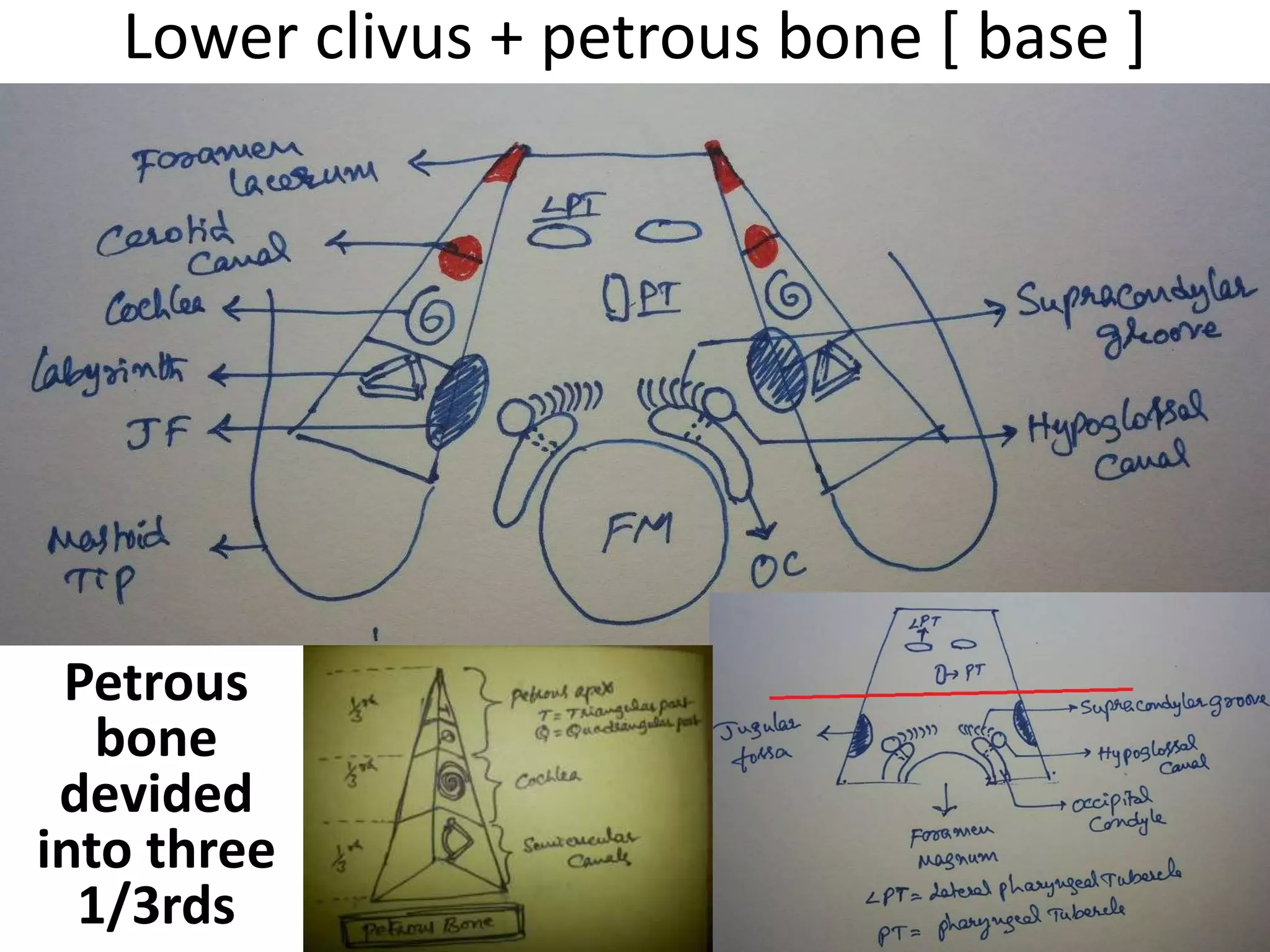 Line along the lateral pharyngeal tubercle [ LPT ] passes through Jugular tubercle [ JT
] – so when you are drilling LPT in anterior skull base you will land up on JT .
Red rings = hypoglossal canals , yellow
ring = pharyngeal tubercle [ PT ] , blue
rings = lateral pharyngeal tubercle [
LPT]
 