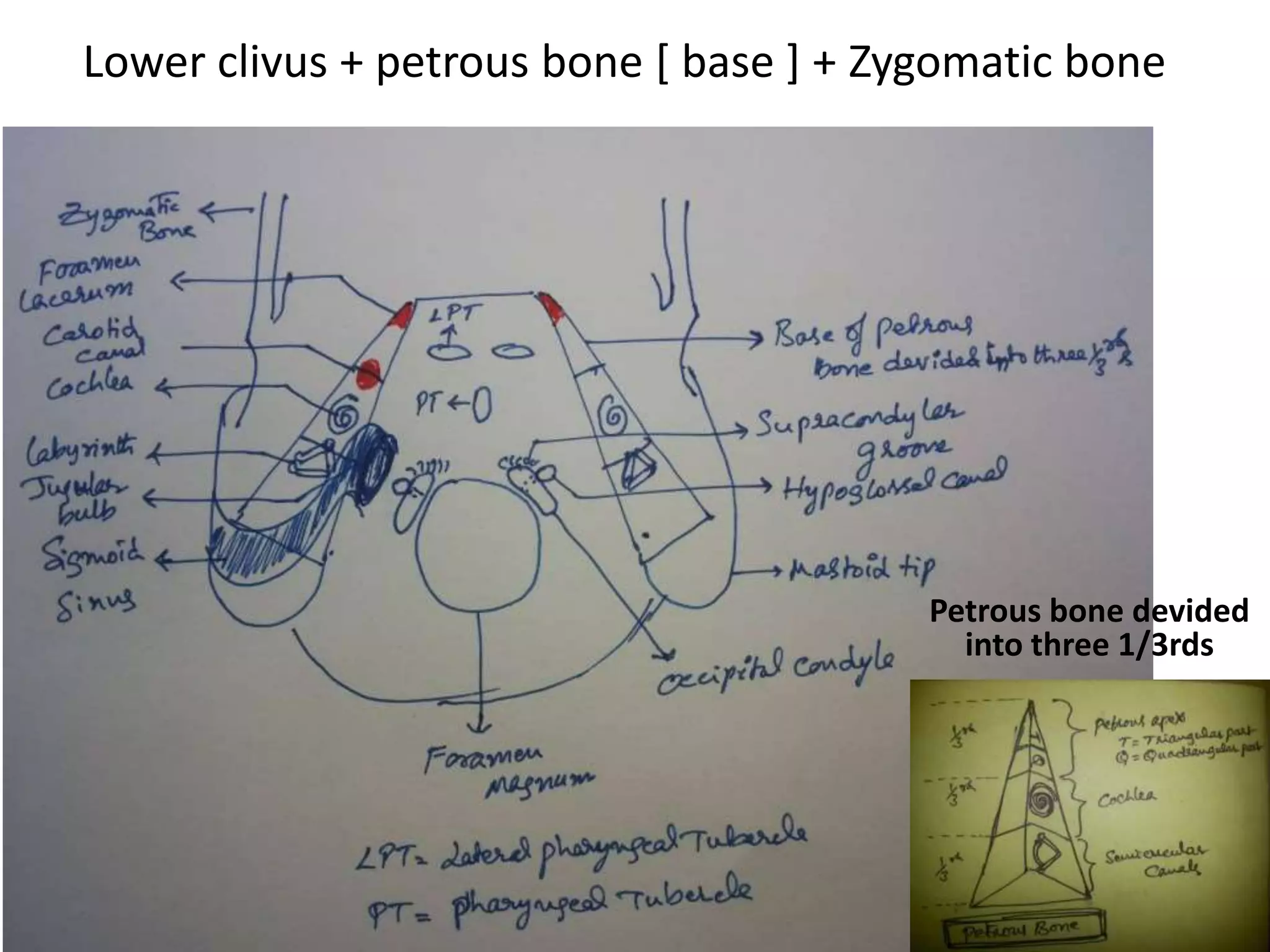 Line along the lateral pharyngeal tubercle [ LPT ] passes through Jugular
tubercle [ JT ] – so when you are drilling LPT in anterior skull base you will
land up on JT .
yellow ring = pharyngeal tubercle [ PT ] , blue rings = lateral pharyngeal
tubercle [ LPT] , green ring = Jugular tubercle
 