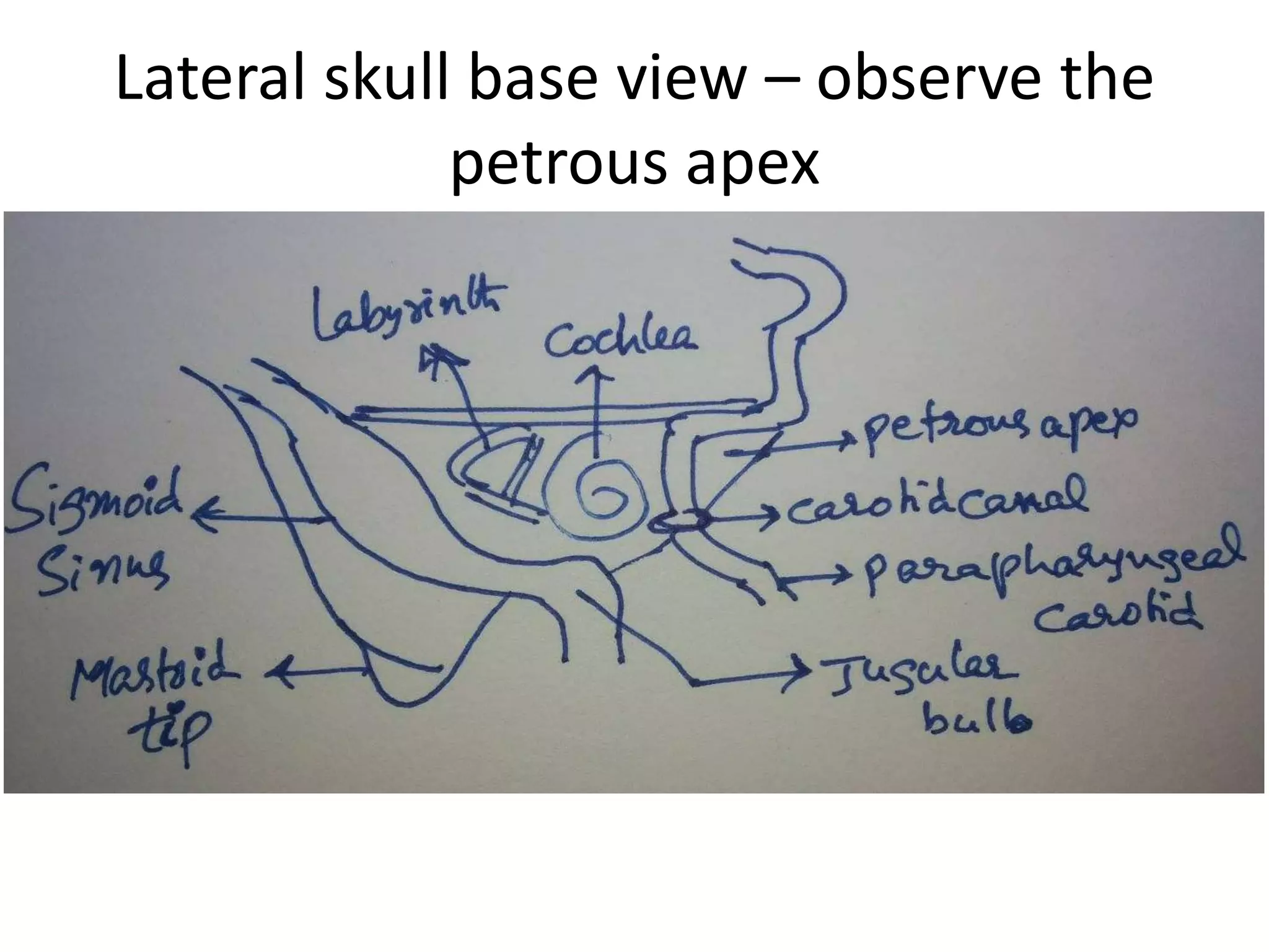 Hypoglossal canals
From front – through nose From back
 