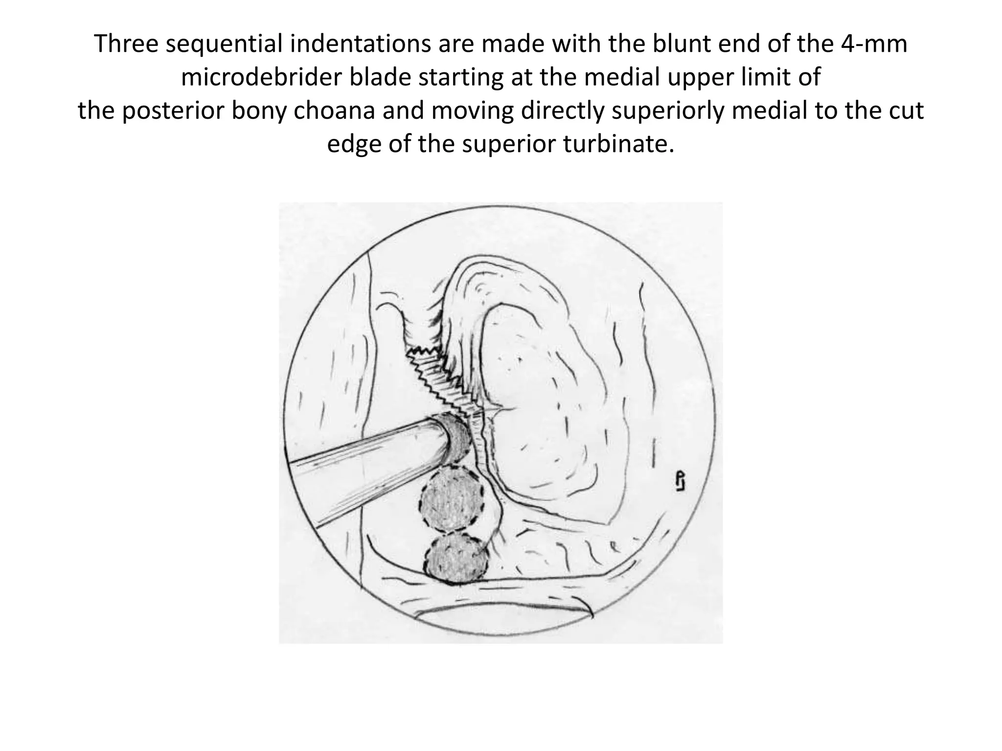 Three sequential indentations are made with the blunt end of the 4-mm
microdebrider blade starting at the medial upper limit of
the posterior bony choana and moving directly superiorly medial to the cut
edge of the superior turbinate.
 