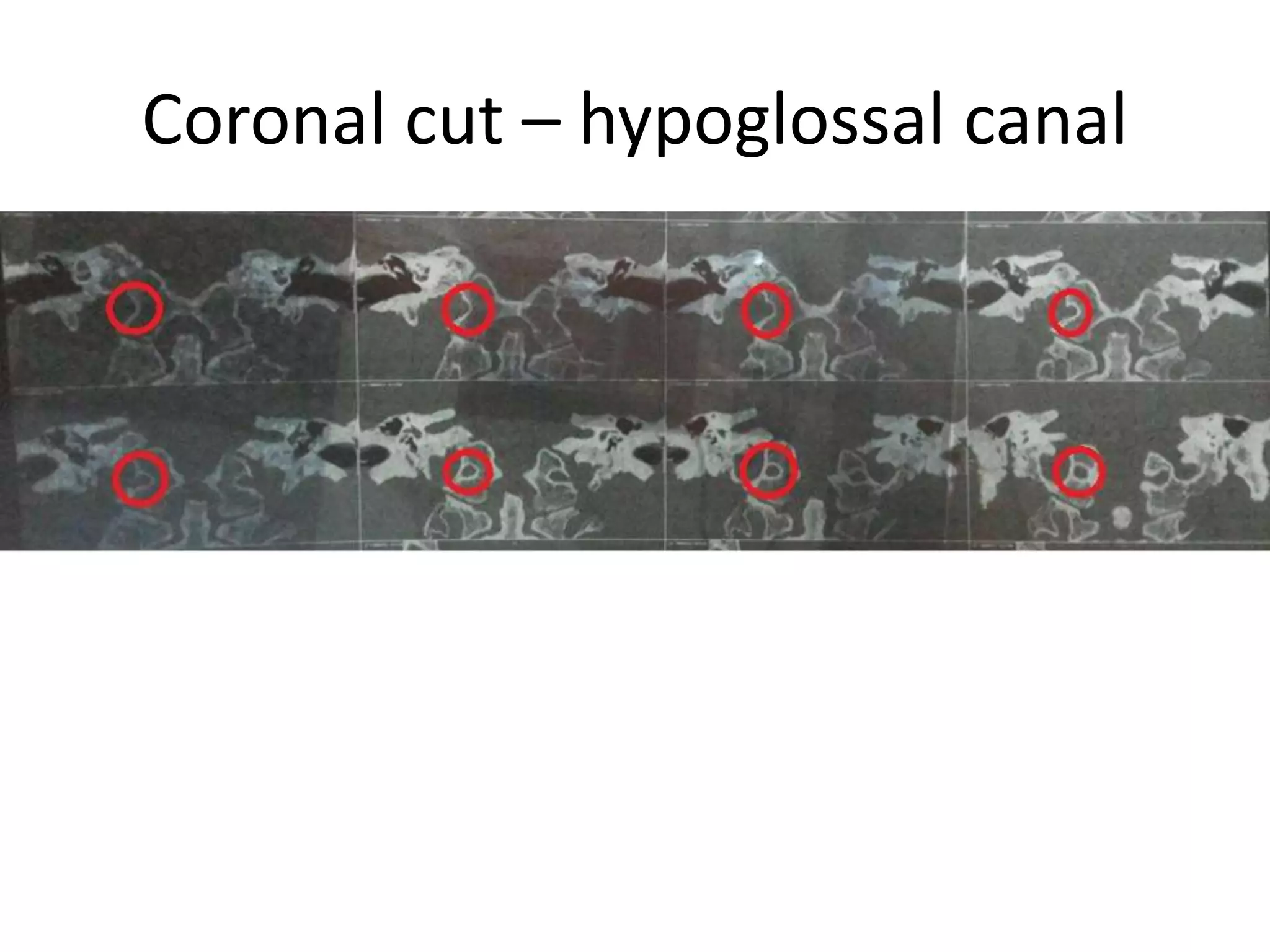 1. 3th nerve between PCA & SCA
2. 4th nerve coming from dorsal
brain stem passes above SCA [ some
times SCA has two branches]
3. 6th nerve originates at VBJ [
Vertebro-basillar junction ] . 6th
nerve may have two rootlets of
origin , one above & one below the
AICA
4. In 30 % of cases AICA passes in
between 7th & 8th nerves
5. PICA passes between two bundles
of 12th nerve & between two roots
of 11th nerve [ 11c = 11th cervical ,
11s = 11th spinal root ]
6. The exit zones of the 6th and 12th
nerves are at the same level [ same
vertical line when view from
Transclival approah ( through lower
clivus ) ]
7. 11th nerve behind left vertebral
artery at cervico-medullary junction
. 11th is closely related to the
vertebral artery (VA) at the point of
dural entrance
 