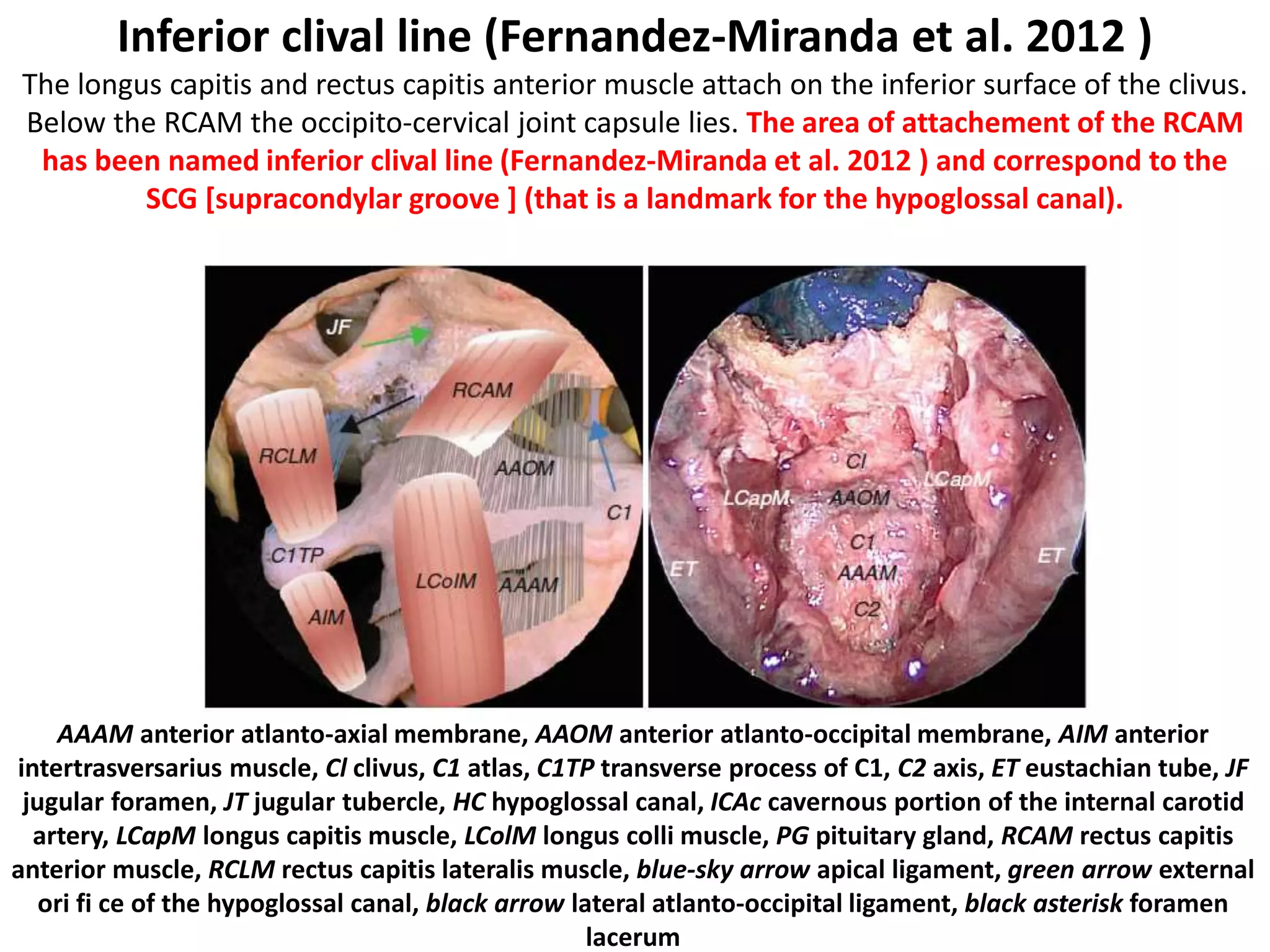 1. 3th nerve between PCA & SCA
2. 4th nerve coming from dorsal brain
stem passes above SCA [ some times SCA
has two branches]
3. 6th nerve originates at VBJ [ Vertebro-
basillar junction ] . 6th nerve may have
two rootlets of origin , one above & one
below the AICA
4. In 30 % of cases AICA passes in
between 7th & 8th nerves
5. PICA passes between two bundles of
12th nerve & between two roots of 11th
nerve [ 11c = 11th cervical , 11s = 11th
spinal root ]
6. The exit zones of the 6th and 12th nerves
are at the same level [ same vertical line
when view from Transclival approah (
through lower clivus ) ]
7. 11th nerve behind left vertebral artery
at cervico-medullary junction . 11th is
closely related to the vertebral artery (VA)
at the point of dural entrance
 