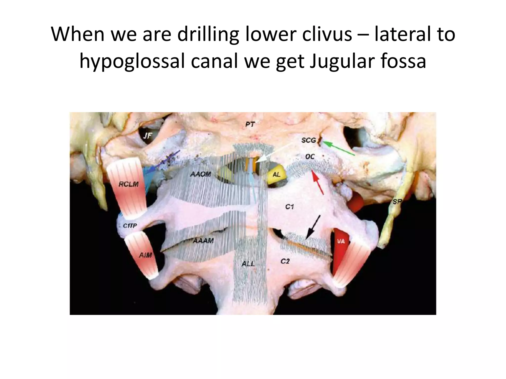 1. Laceral carotid & jugular
tubercle & lower cranial
nerves 9th ,10th ,11th are in
the same line .
2. hypoglossal canal present
between occipital
condyle/foramen magnum &
jugular tubercle
 