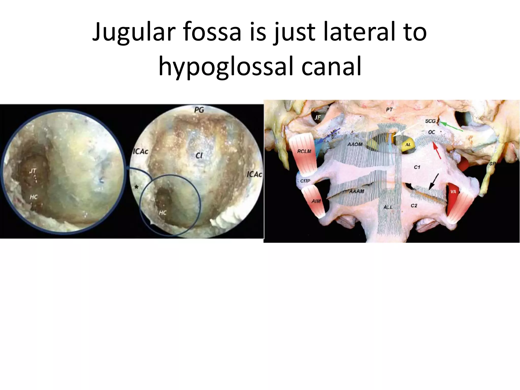 1. Laceral carotid & jugular tubercle & lower cranial nerves 9th ,10th ,11th are in the same
saggital line .
2. hypoglossal canal present between occipital condyle/foramen magnum & jugular tubercle
3. PICA passes between two bundles of 12th nerve & between two roots of 11th nerve [ 11c =
11th cervical , 11s = 11th spinal root ] & encirlces lower cranial nerves 9th ,10th ,11th
 