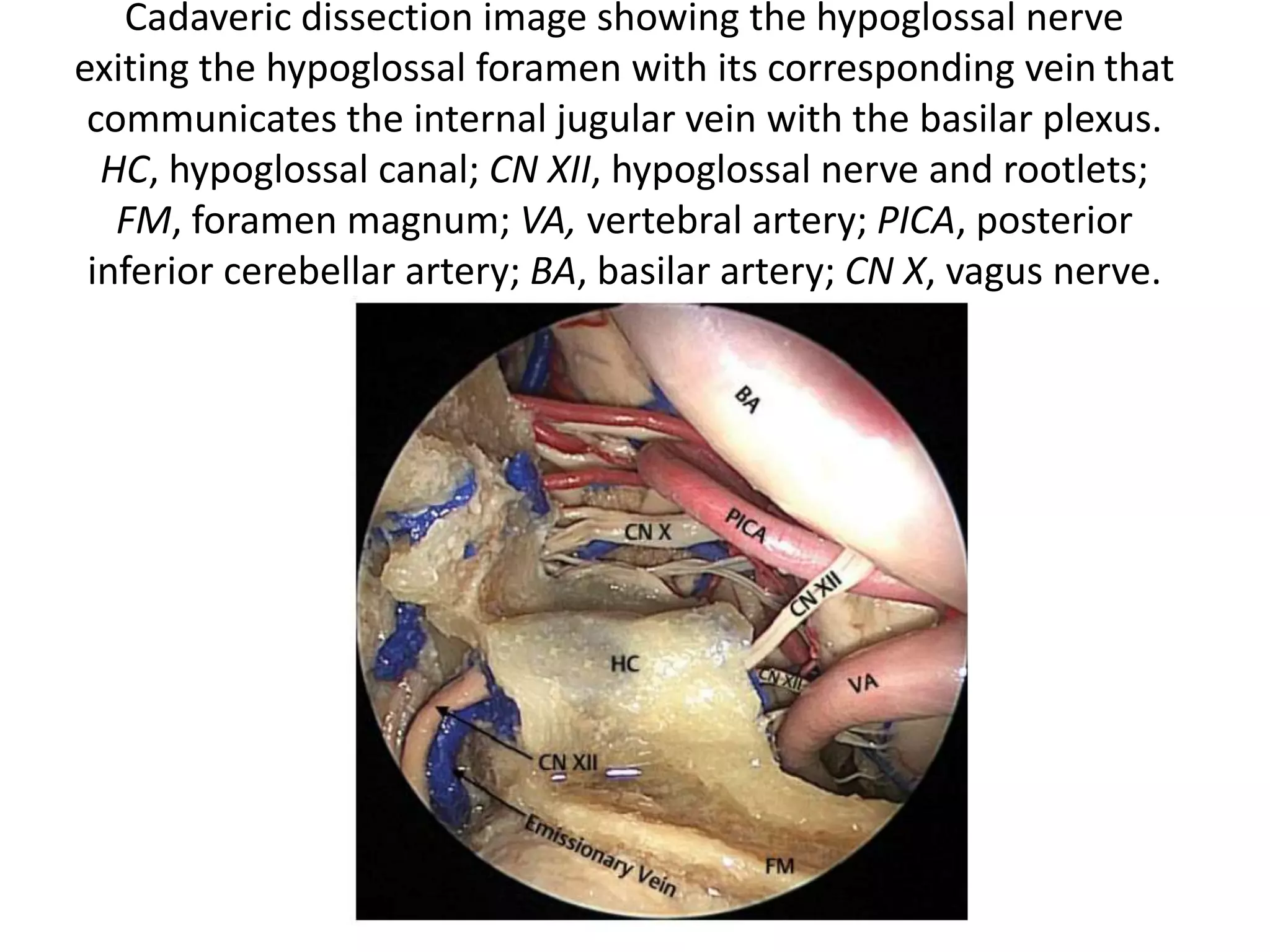 Coronal cut – hypoglossal canal
 