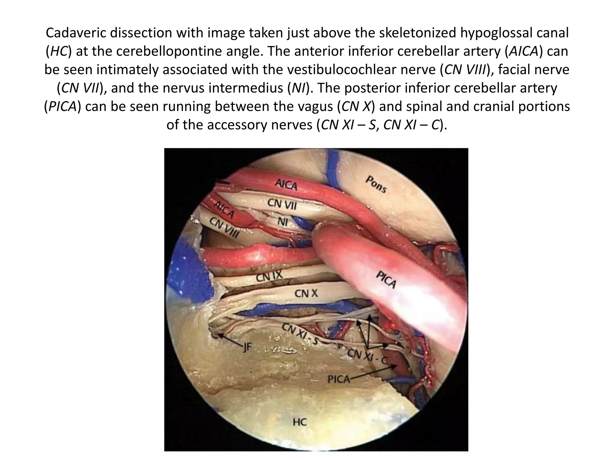Inferior clival line (Fernandez-Miranda et al. 2012 )
The longus capitis and rectus capitis anterior muscle attach on the inferior surface of the clivus.
Below the RCAM the occipito-cervical joint capsule lies. The area of attachement of the RCAM
has been named inferior clival line (Fernandez-Miranda et al. 2012 ) and correspond to the
SCG [supracondylar groove ] (that is a landmark for the hypoglossal canal).
AAAM anterior atlanto-axial membrane, AAOM anterior atlanto-occipital membrane, AIM anterior
intertrasversarius muscle, Cl clivus, C1 atlas, C1TP transverse process of C1, C2 axis, ET eustachian tube, JF
jugular foramen, JT jugular tubercle, HC hypoglossal canal, ICAc cavernous portion of the internal carotid
artery, LCapM longus capitis muscle, LColM longus colli muscle, PG pituitary gland, RCAM rectus capitis
anterior muscle, RCLM rectus capitis lateralis muscle, blue-sky arrow apical ligament, green arrow external
ori fi ce of the hypoglossal canal, black arrow lateral atlanto-occipital ligament, black asterisk foramen
lacerum
 