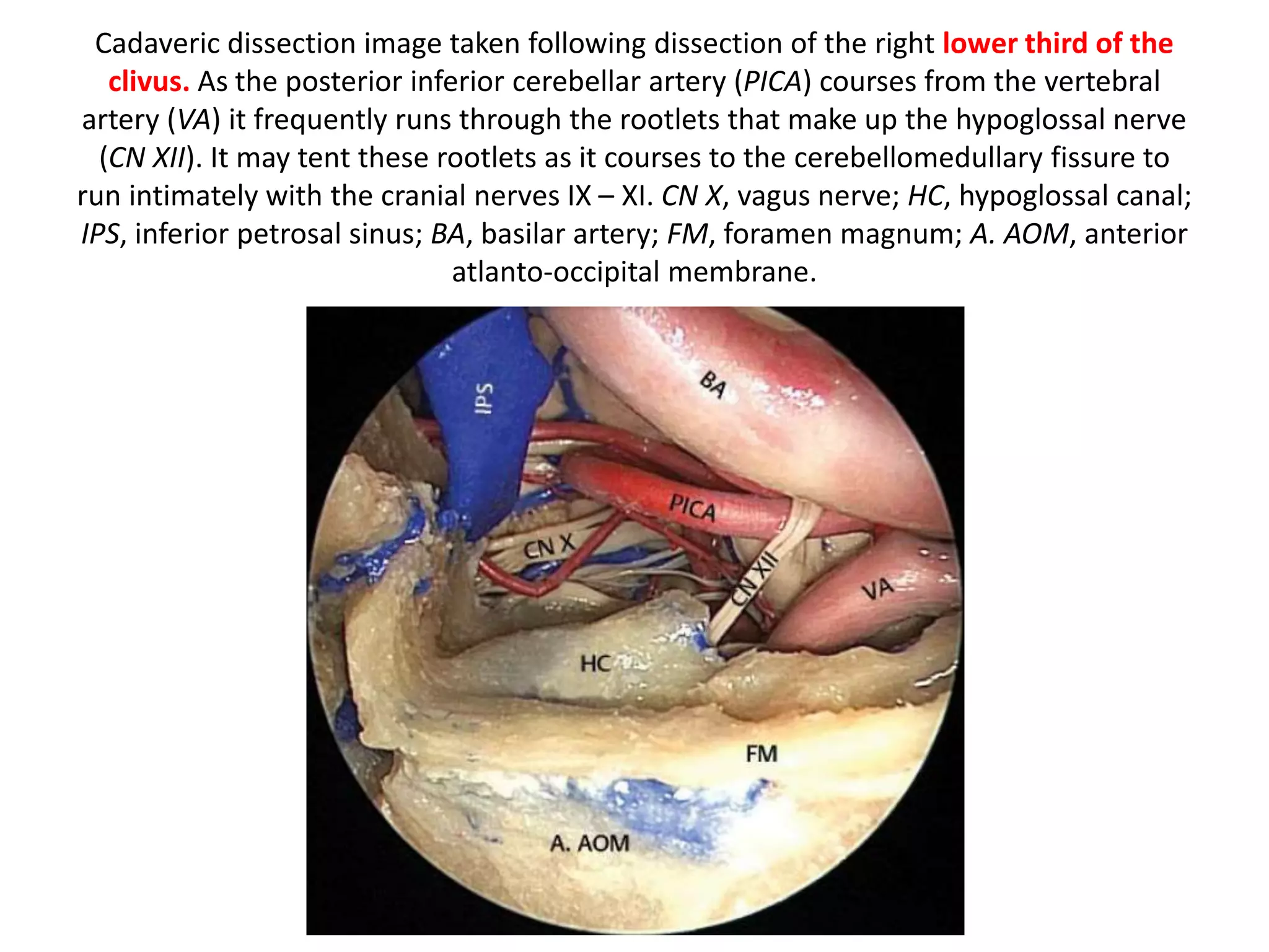The area of attachement of the RCAM has been named inferior clival line
(Fernandez-Miranda et al. 2012 ) and correspond to the SCG [supracondylar
groove ] (that is a landmark for the hypoglossal canal).
SCG = Supracondylar groove – is an important landmark to hypoglossal canal
 