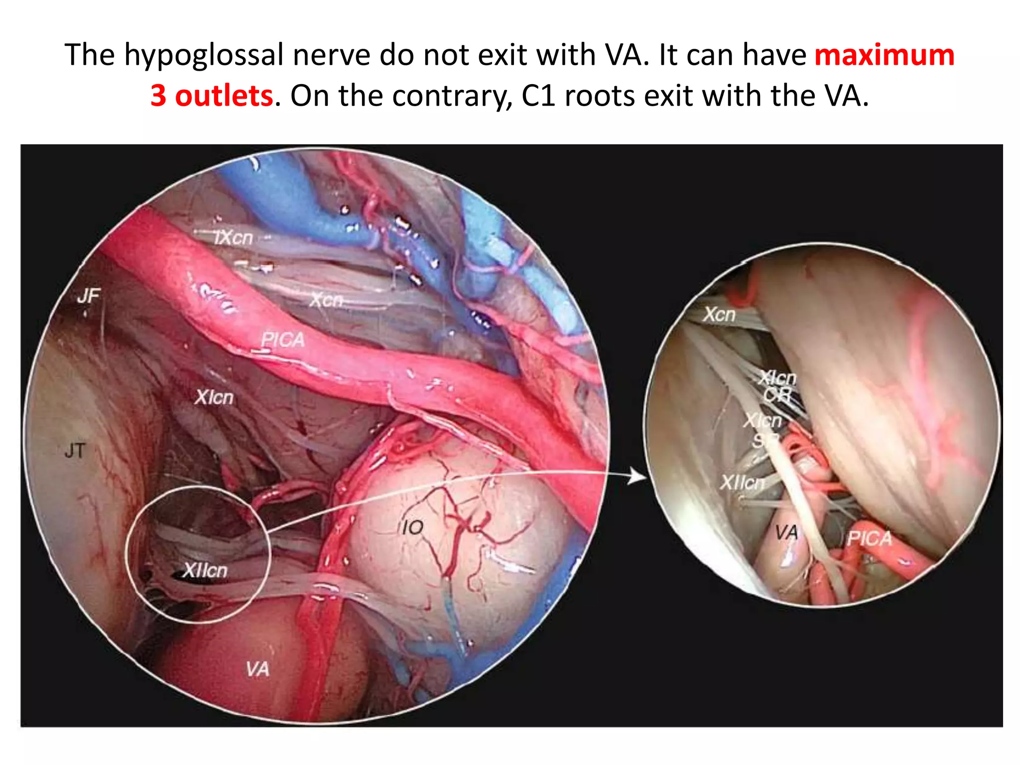 When we are drilling lower clivus – lateral to
hypoglossal canal we get Jugular fossa
 