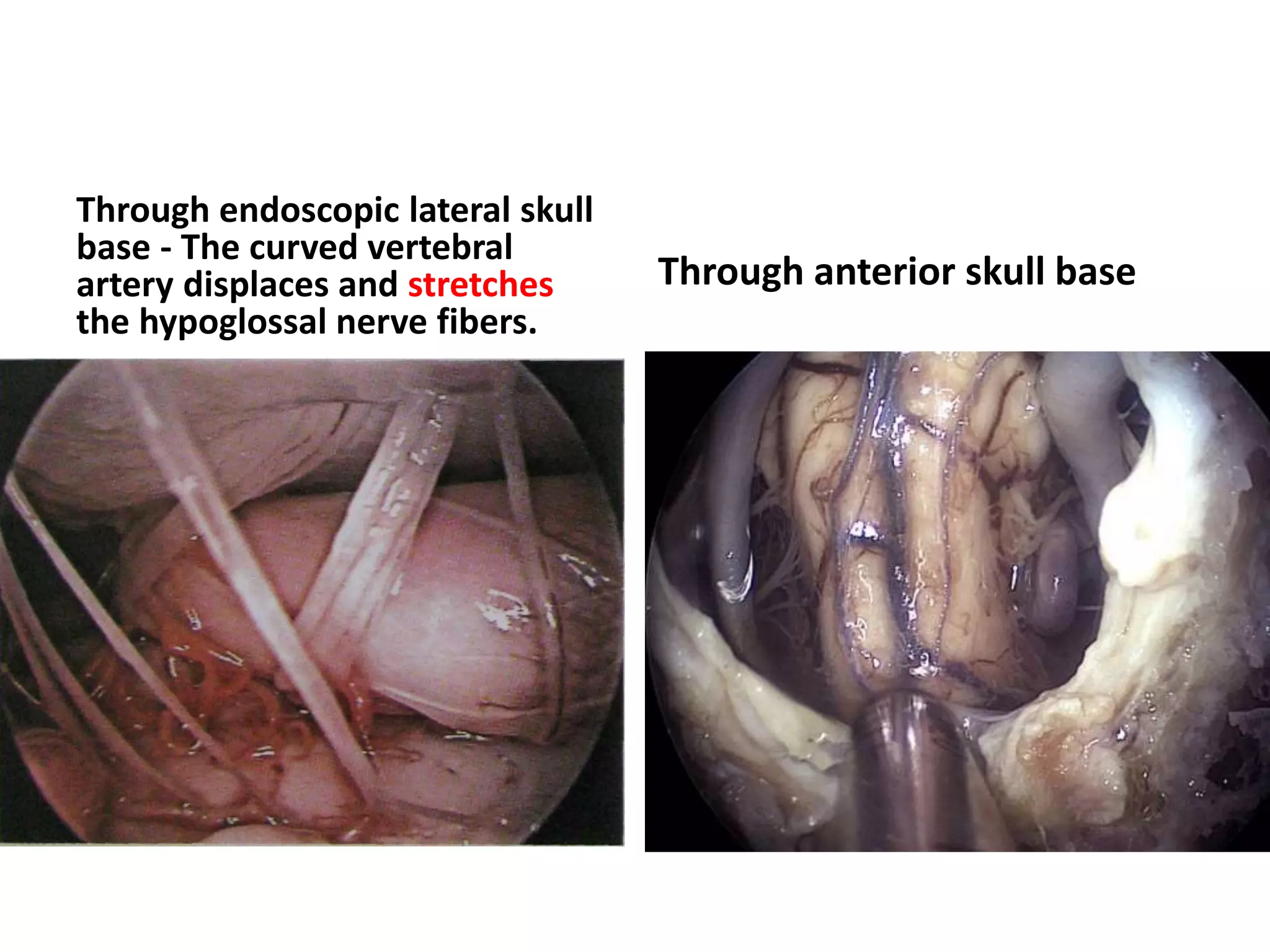 Jugular fossa is just lateral to
hypoglossal canal
 