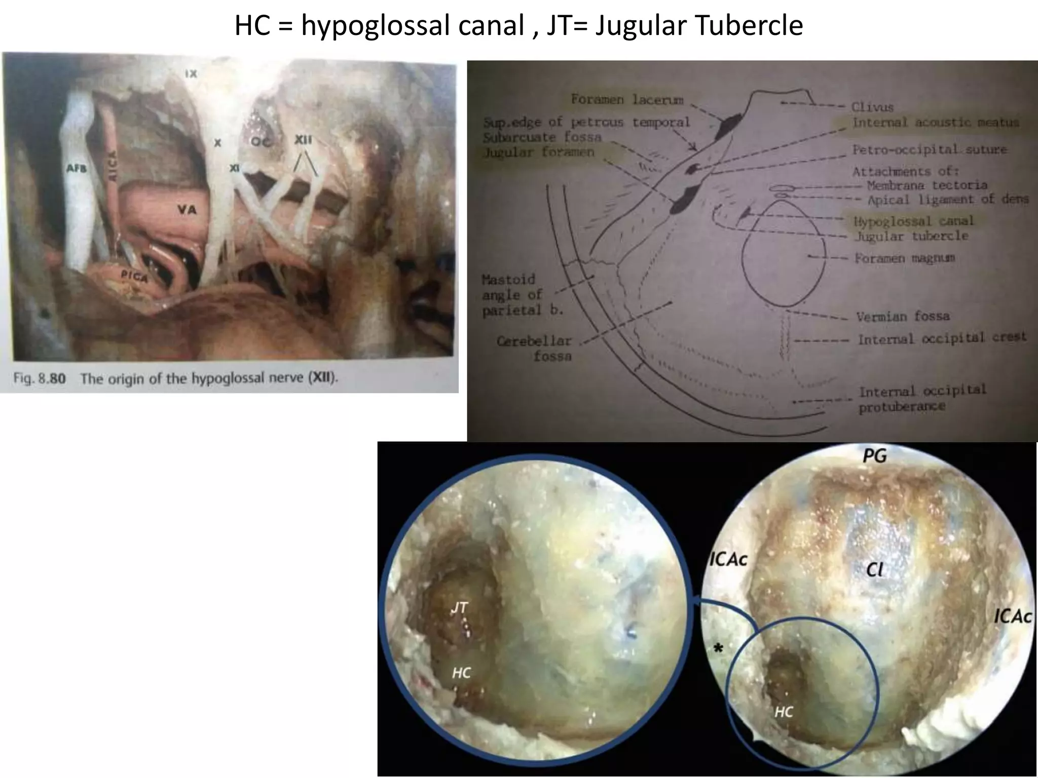 Cadaveric dissection image demonstrating structures seen
following dissection of the lower third of the clivus. Note how
the basilar arteries and vertebral arteries can be extremely
tortuous in their course.
 