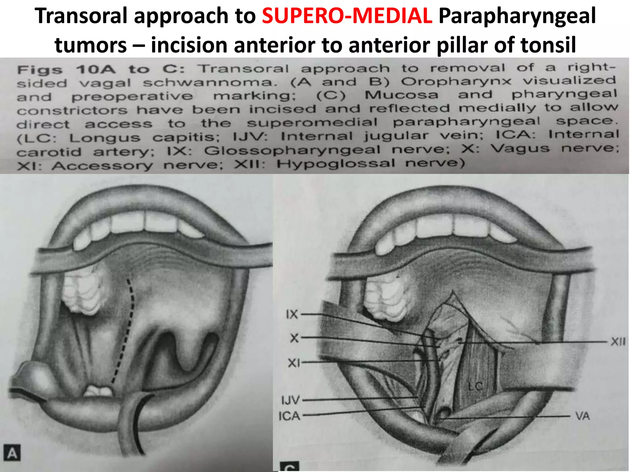 Cadaveric dissection image showing the hypoglossal nerve
exiting the hypoglossal foramen with its corresponding vein that
communicates the internal jugular vein with the basilar plexus.
HC, hypoglossal canal; CN XII, hypoglossal nerve and rootlets;
FM, foramen magnum; VA, vertebral artery; PICA, posterior
inferior cerebellar artery; BA, basilar artery; CN X, vagus nerve.
 