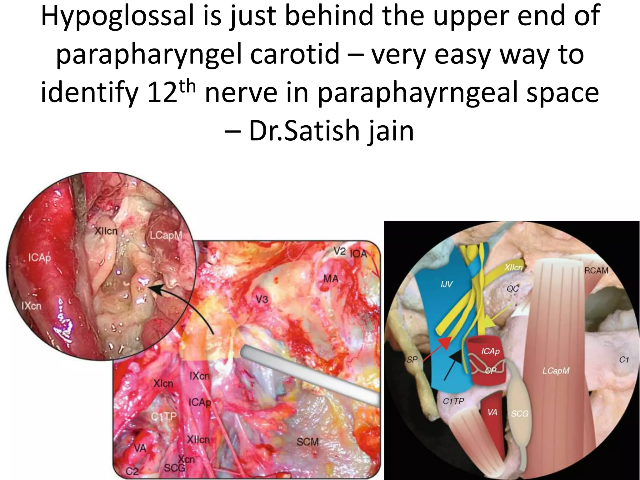 Cadaveric dissection with image taken just above the skeletonized hypoglossal canal
(HC) at the cerebellopontine angle. The anterior inferior cerebellar artery (AICA) can
be seen intimately associated with the vestibulocochlear nerve (CN VIII), facial nerve
(CN VII), and the nervus intermedius (NI). The posterior inferior cerebellar artery
(PICA) can be seen running between the vagus (CN X) and spinal and cranial portions
of the accessory nerves (CN XI – S, CN XI – C).
 