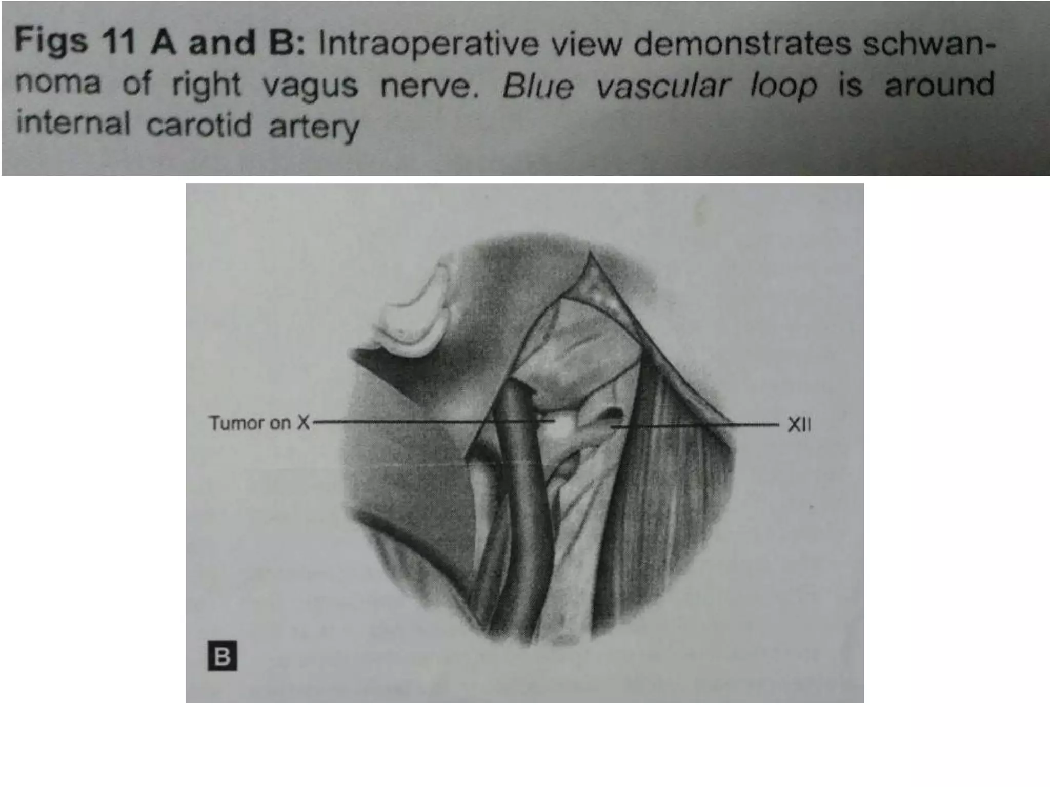 Cadaveric dissection image taken following dissection of the right lower third of the
clivus. As the posterior inferior cerebellar artery (PICA) courses from the vertebral
artery (VA) it frequently runs through the rootlets that make up the hypoglossal nerve
(CN XII). It may tent these rootlets as it courses to the cerebellomedullary fissure to
run intimately with the cranial nerves IX – XI. CN X, vagus nerve; HC, hypoglossal canal;
IPS, inferior petrosal sinus; BA, basilar artery; FM, foramen magnum; A. AOM, anterior
atlanto-occipital membrane.
 