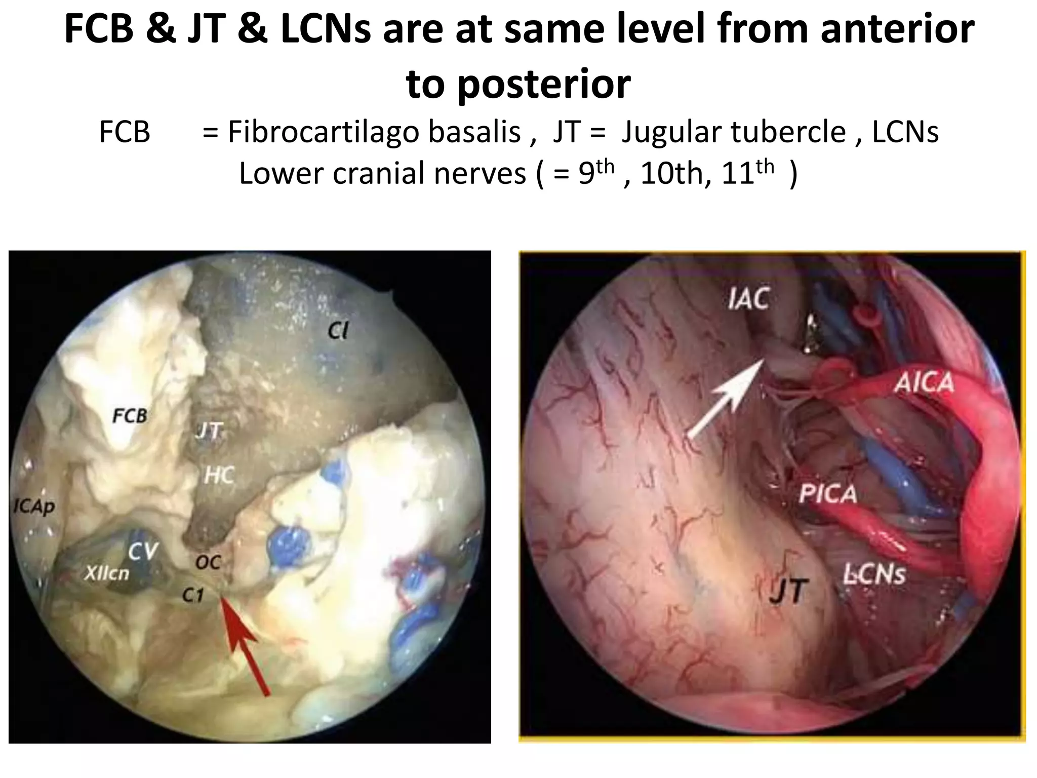 The hypoglossal nerve do not exit with VA. It can have maximum
3 outlets. On the contrary, C1 roots exit with the VA.
 